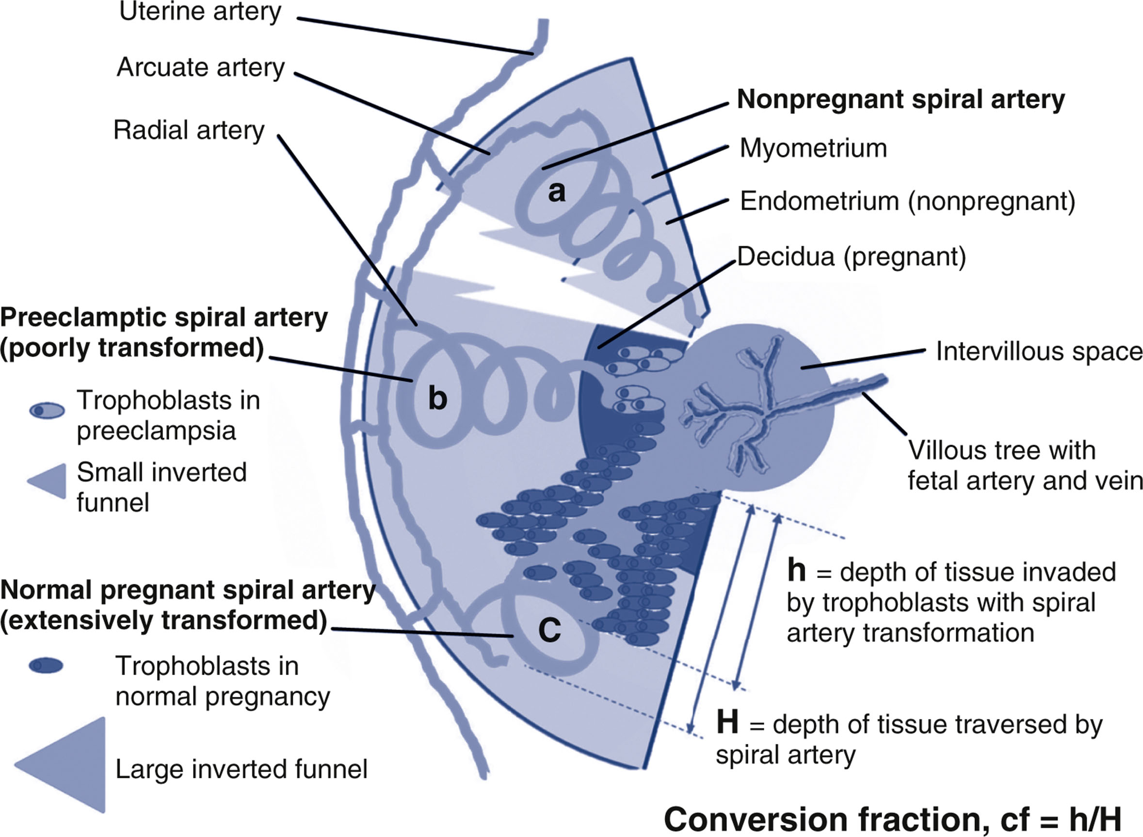 A schematic shows spiral artery structure in nonpregnancy, preeclamptic pregnancy, and normal pregnancy, with varying trophoblast invasion and funnel size.