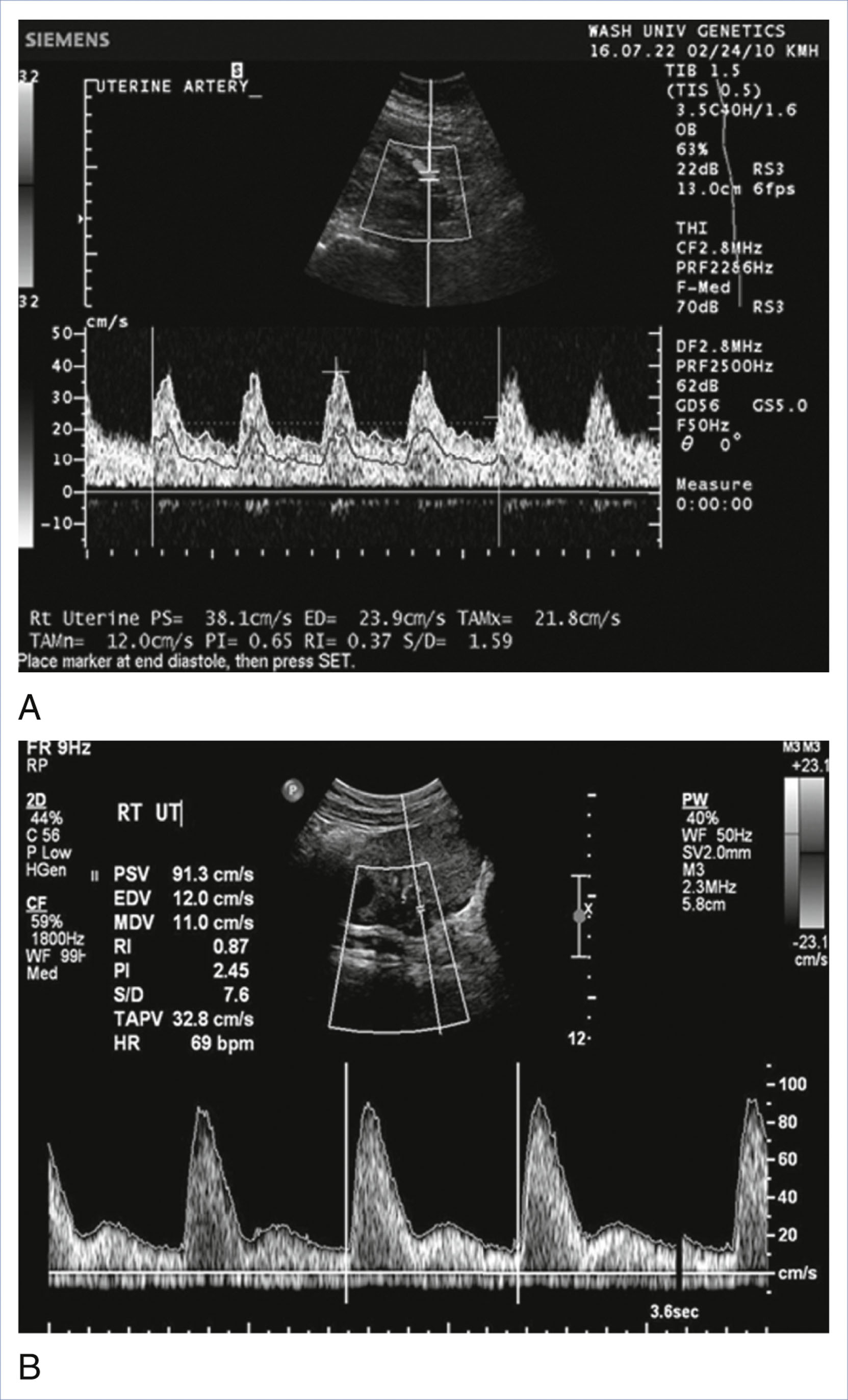 A Doppler ultrasound panel shows a normal uterine artery waveform without notching and an abnormal waveform with notching and increased pulsatility.