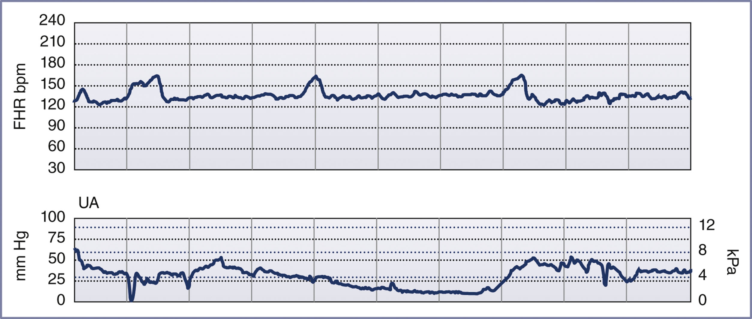 A dual-panel chart displays fetal heart rate and uterine activity with a steady baseline and periodic accelerations.