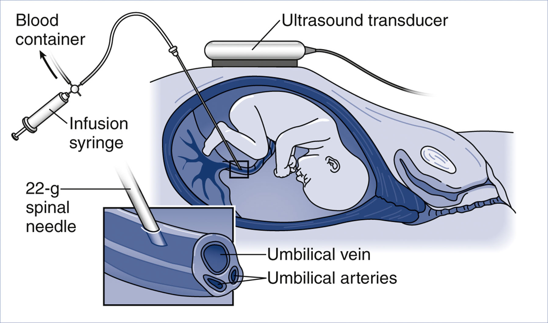 An illustration shows intrauterine umbilical cord blood sampling and transfusion guided by ultrasound.