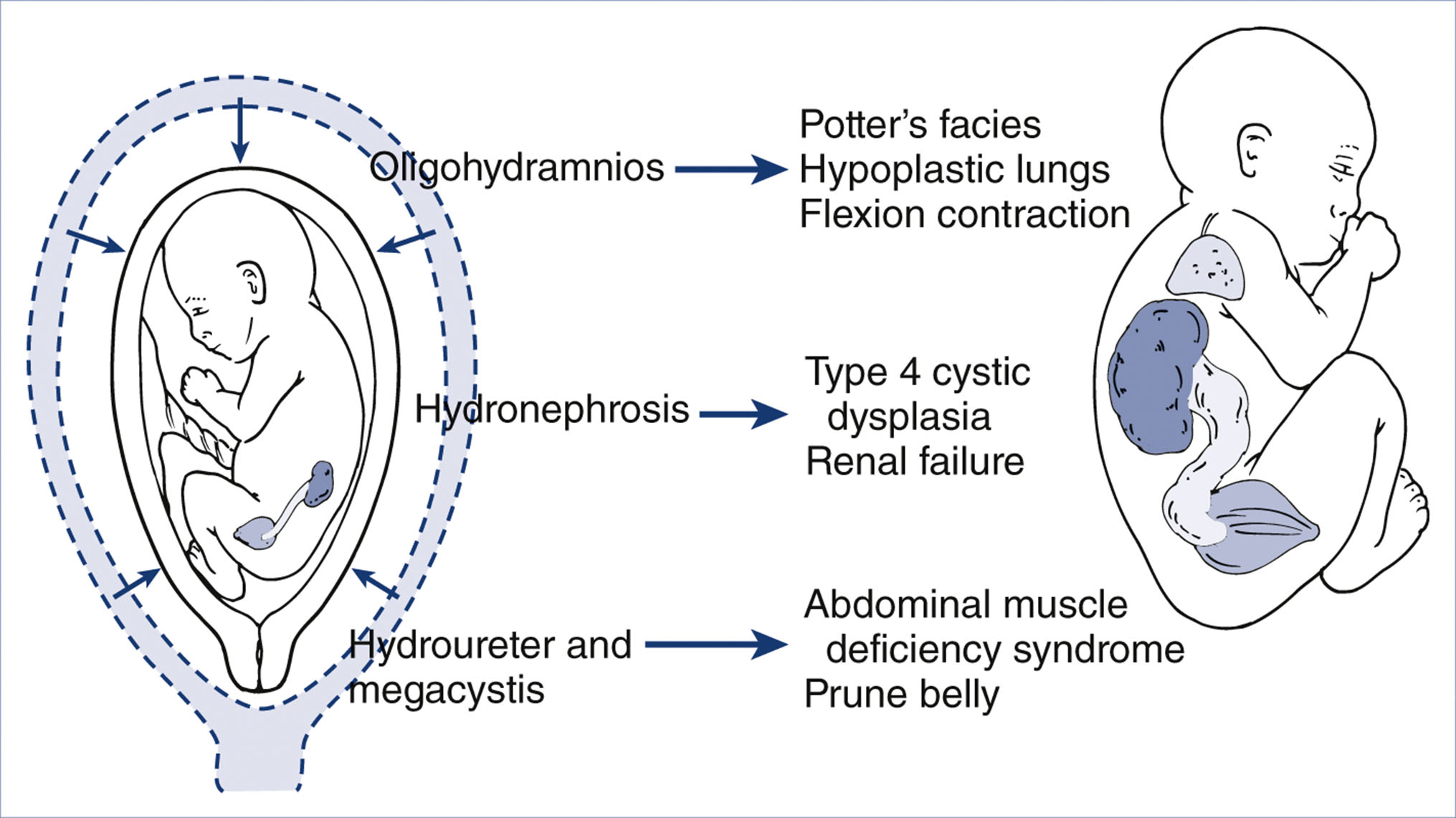 An illustration shows developmental outcomes of fetal urethral obstruction.