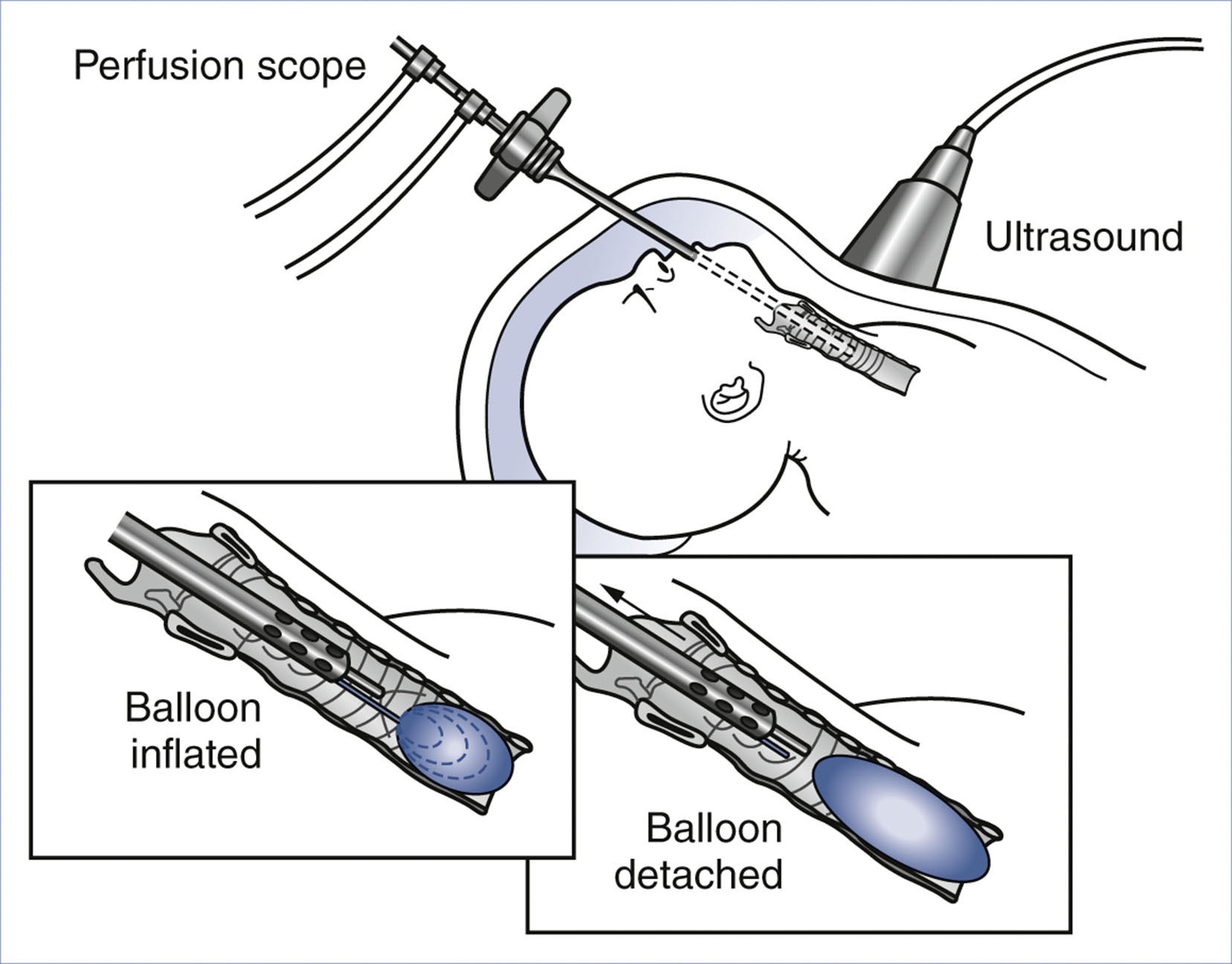 An illustration shows fetal tracheal occlusion using a balloon under ultrasound guidance.