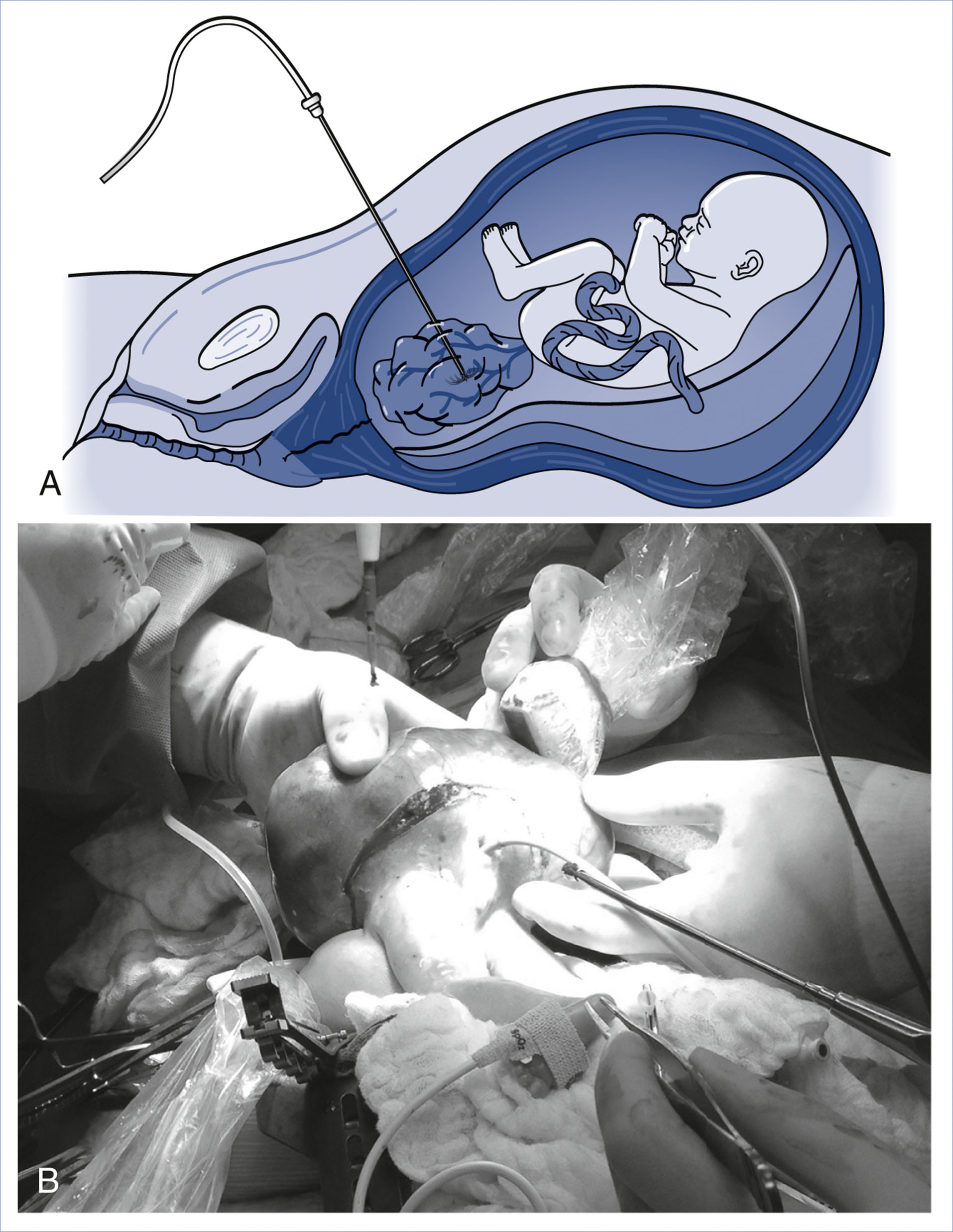 A composite of an illustration and a photograph shows the in utero treatment of sacrococcygeal teratoma.