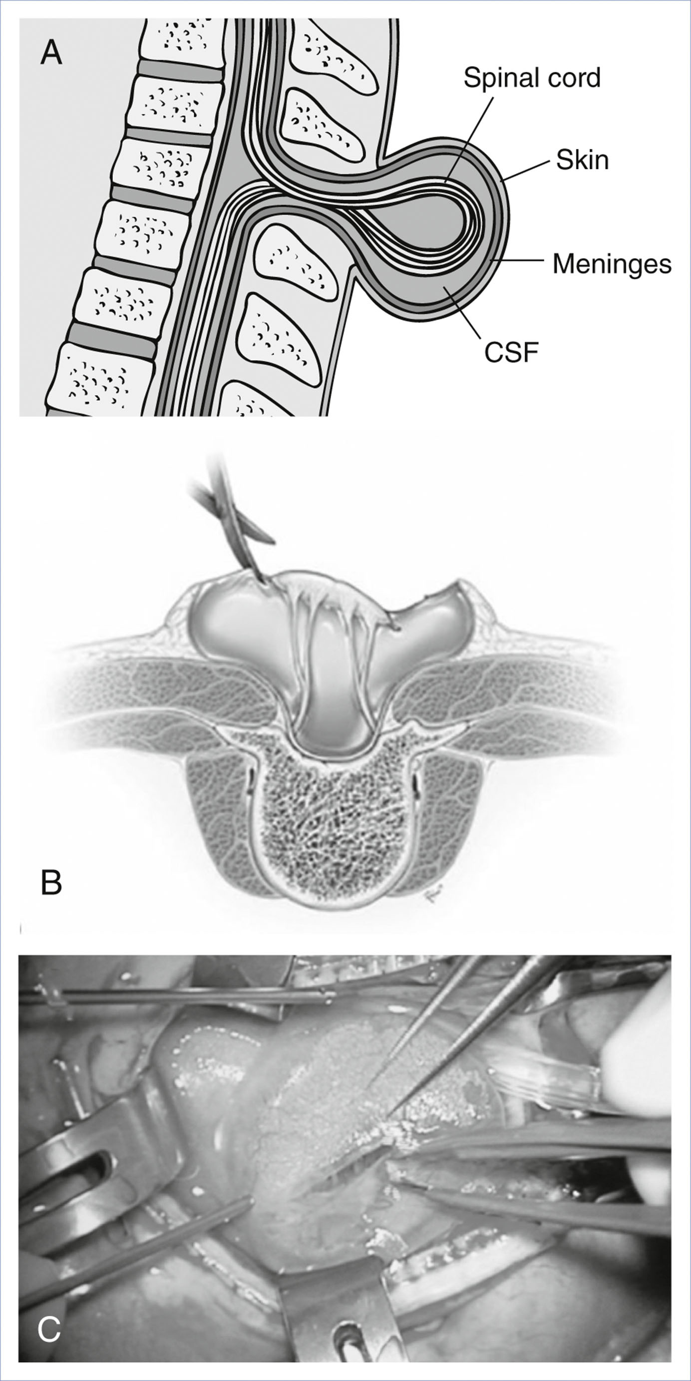 A composite of two illustrations and a photograph shows the anatomy and surgical repair of myelomeningocele.