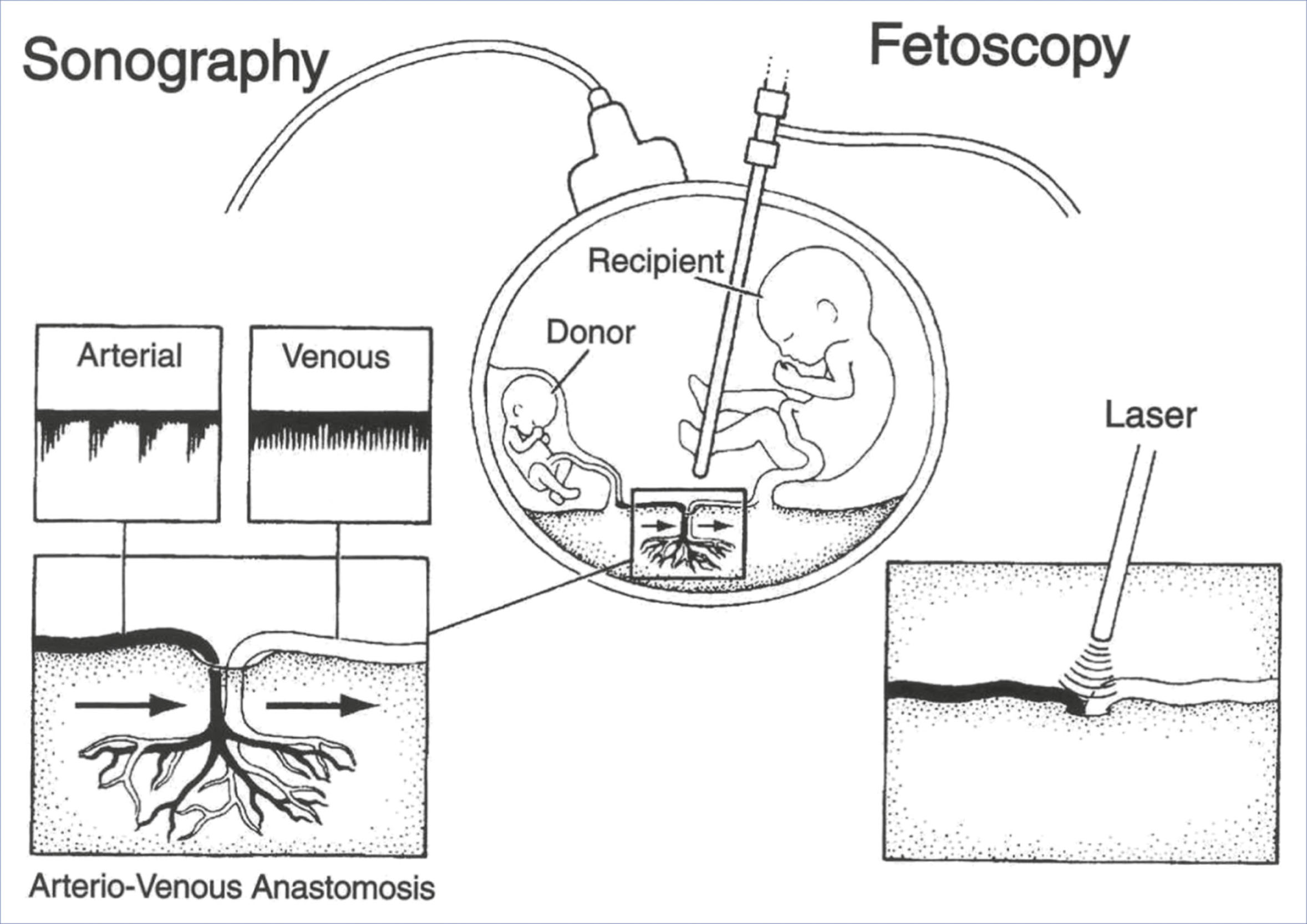 An illustration shows fetoscopic laser ablation for twin-to-twin transfusion syndrome guided by ultrasound.