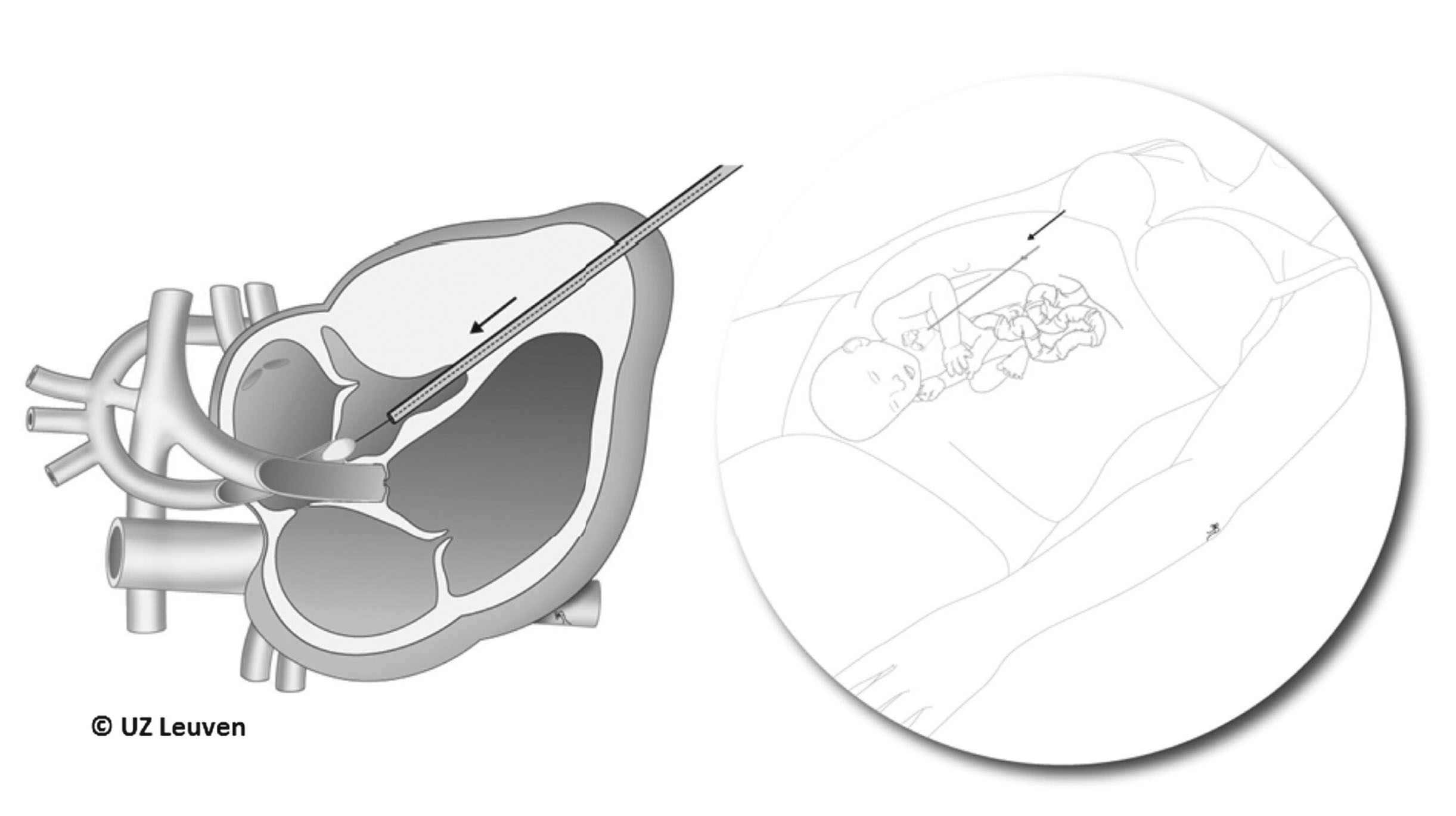 An illustration shows percutaneous fetal aortic valvuloplasty for hypoplastic left heart syndrome.