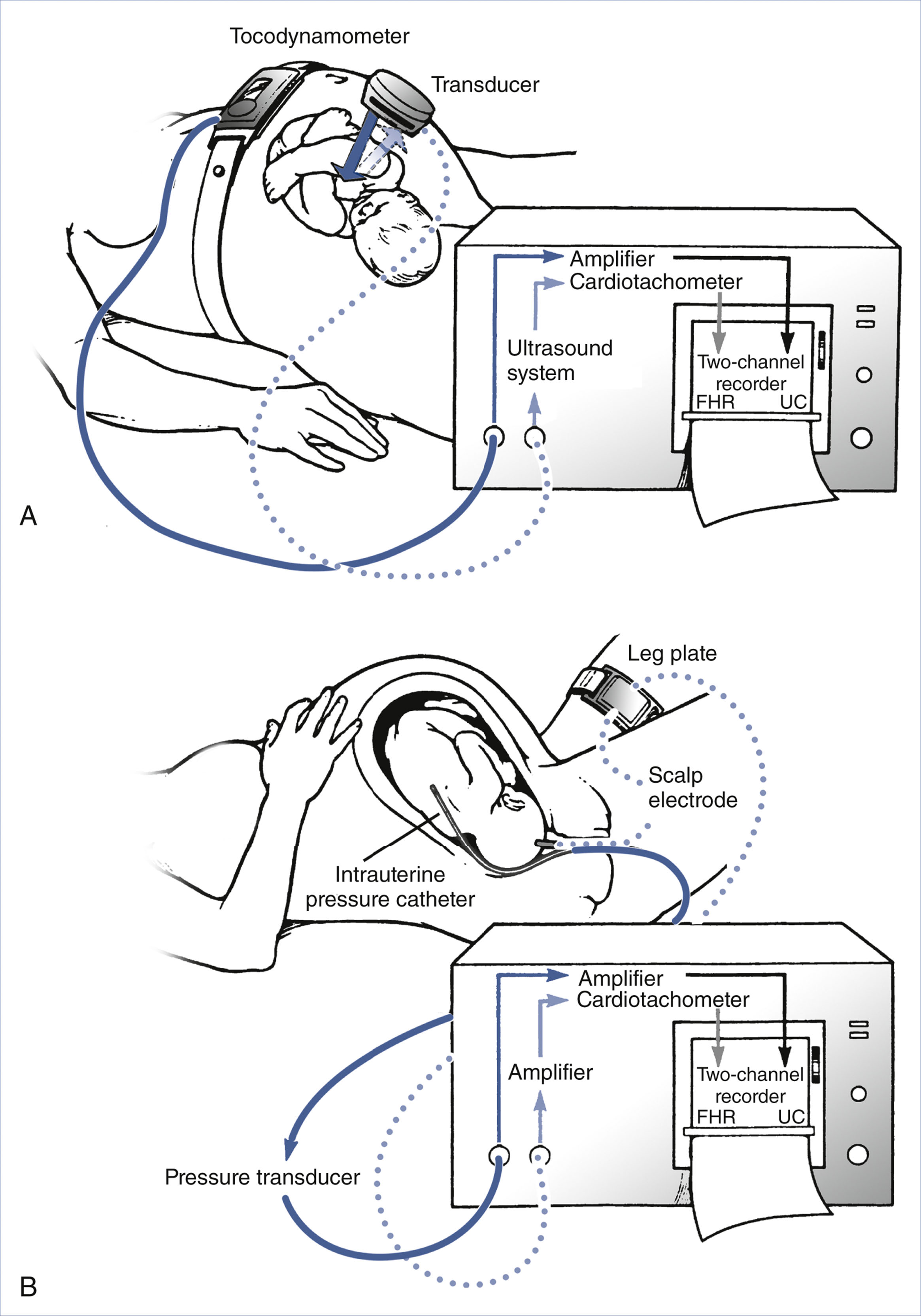 A medical diagram presents external and internal electronic fetal monitoring setups using sensors and recording devices.