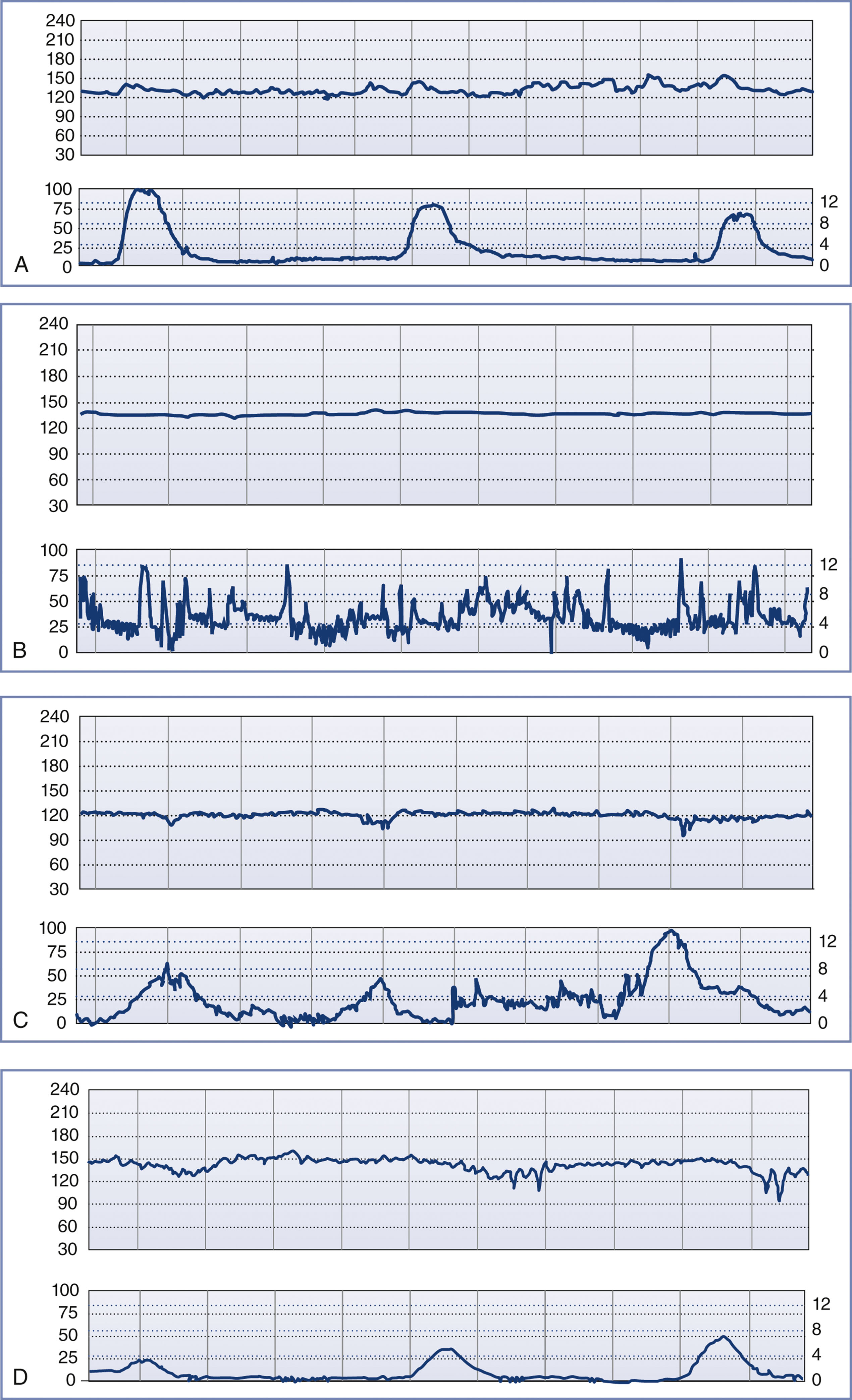A fetal monitoring tracing shows fetal heart rate and uterine contractions with repeated variable decelerations.