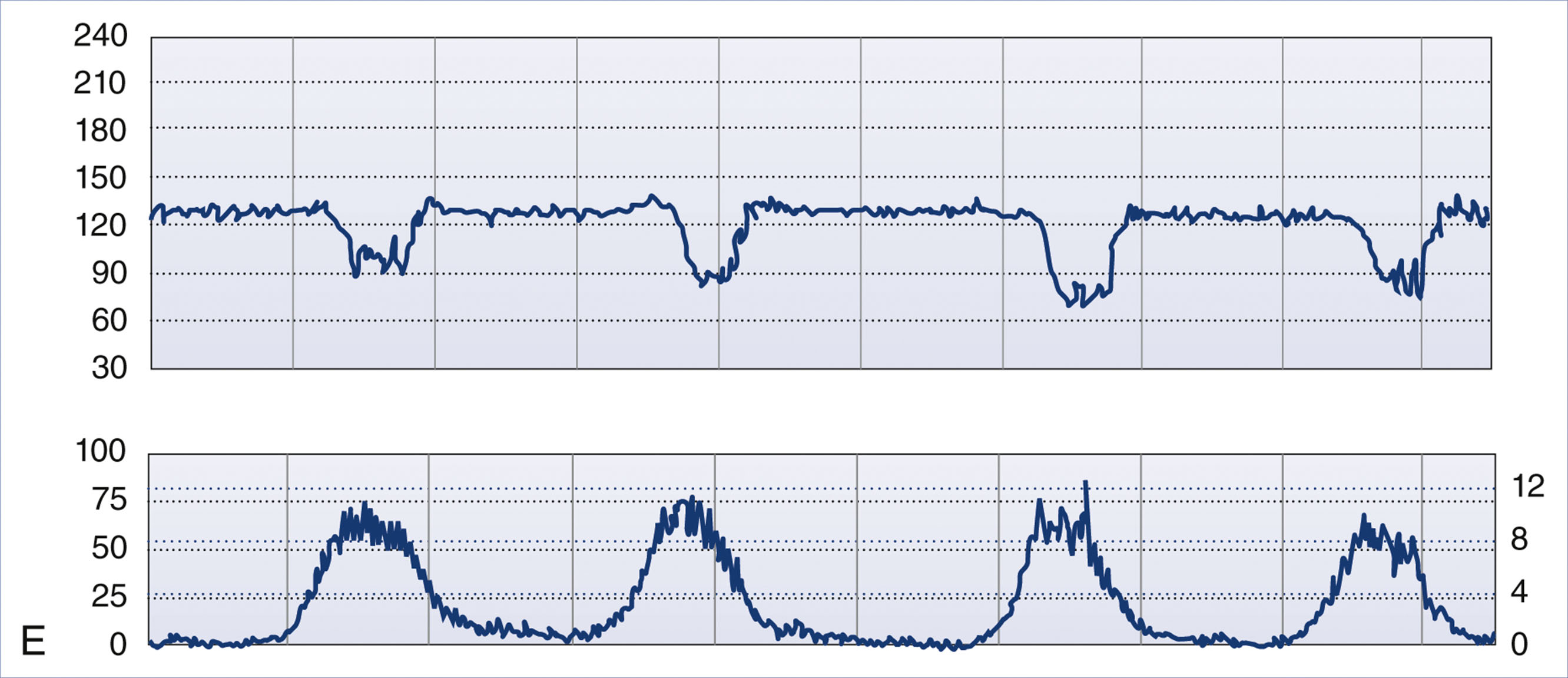 A fetal monitoring tracing shows fetal heart rate and uterine contractions with repeated variable decelerations.