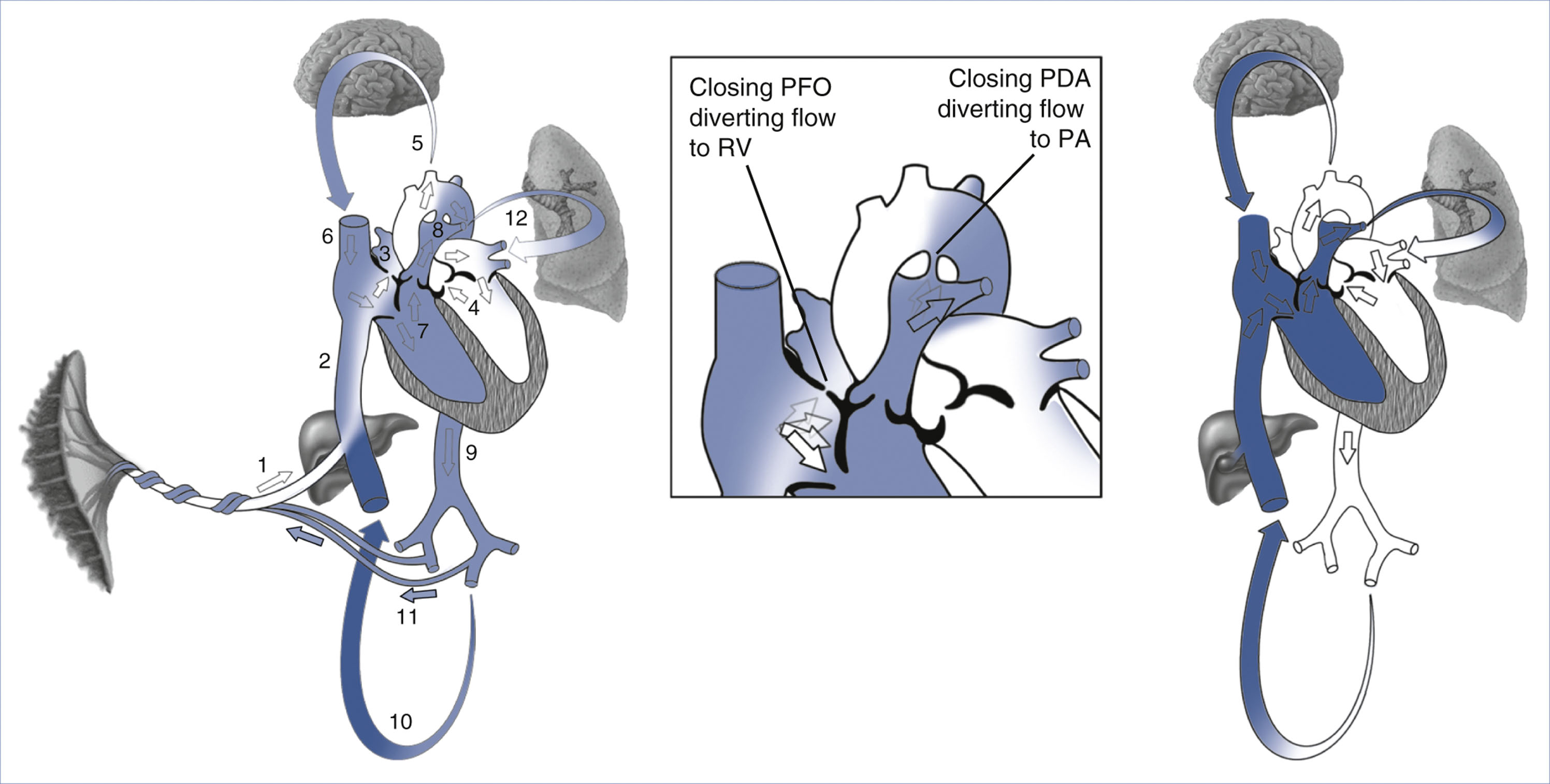A three-part diagram shows fetal, transitional, and neonatal circulation pathways with labeled blood flow directions.