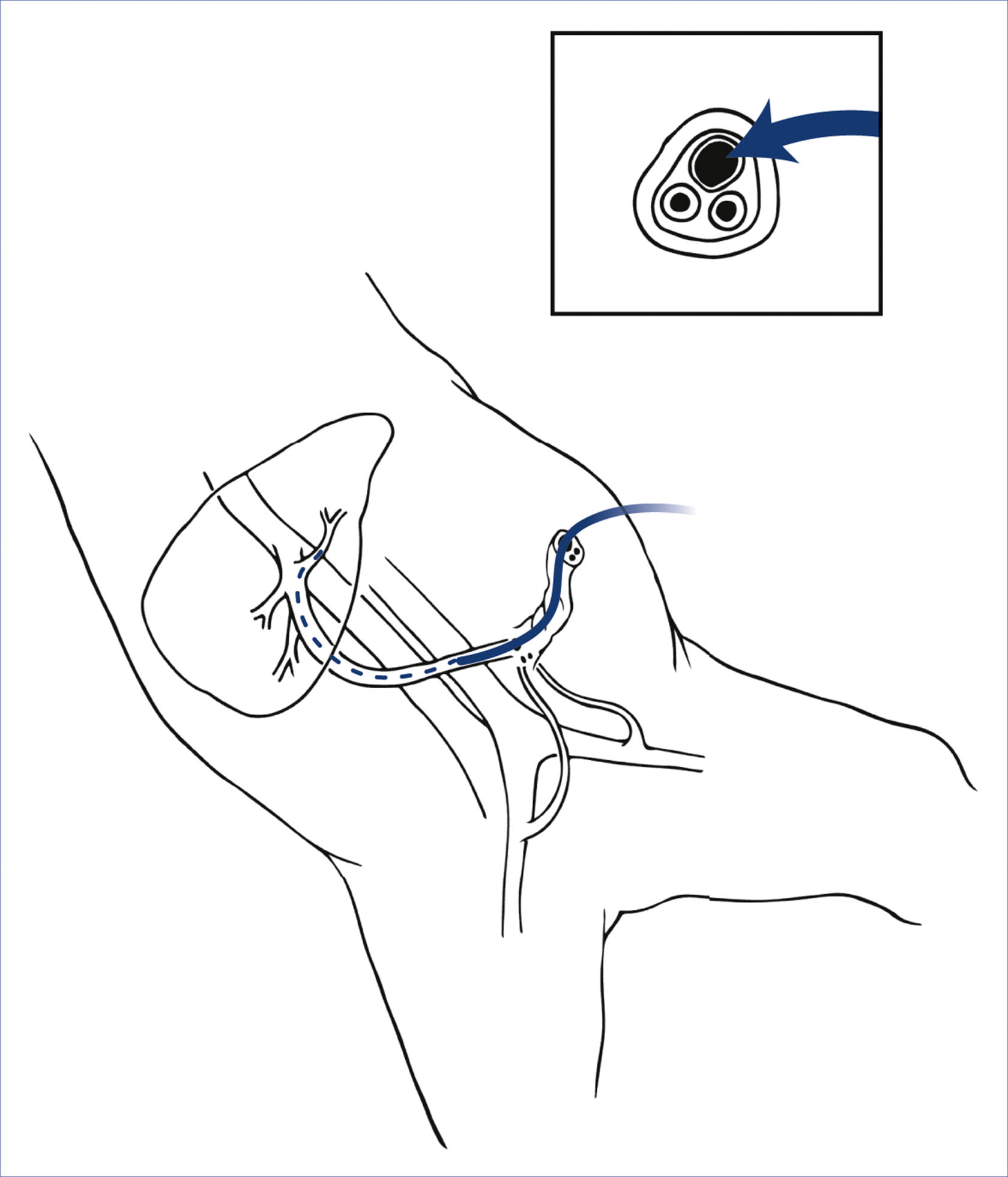 An anatomical diagram shows cannulation of the umbilical vein with catheter placement below the skin level.
