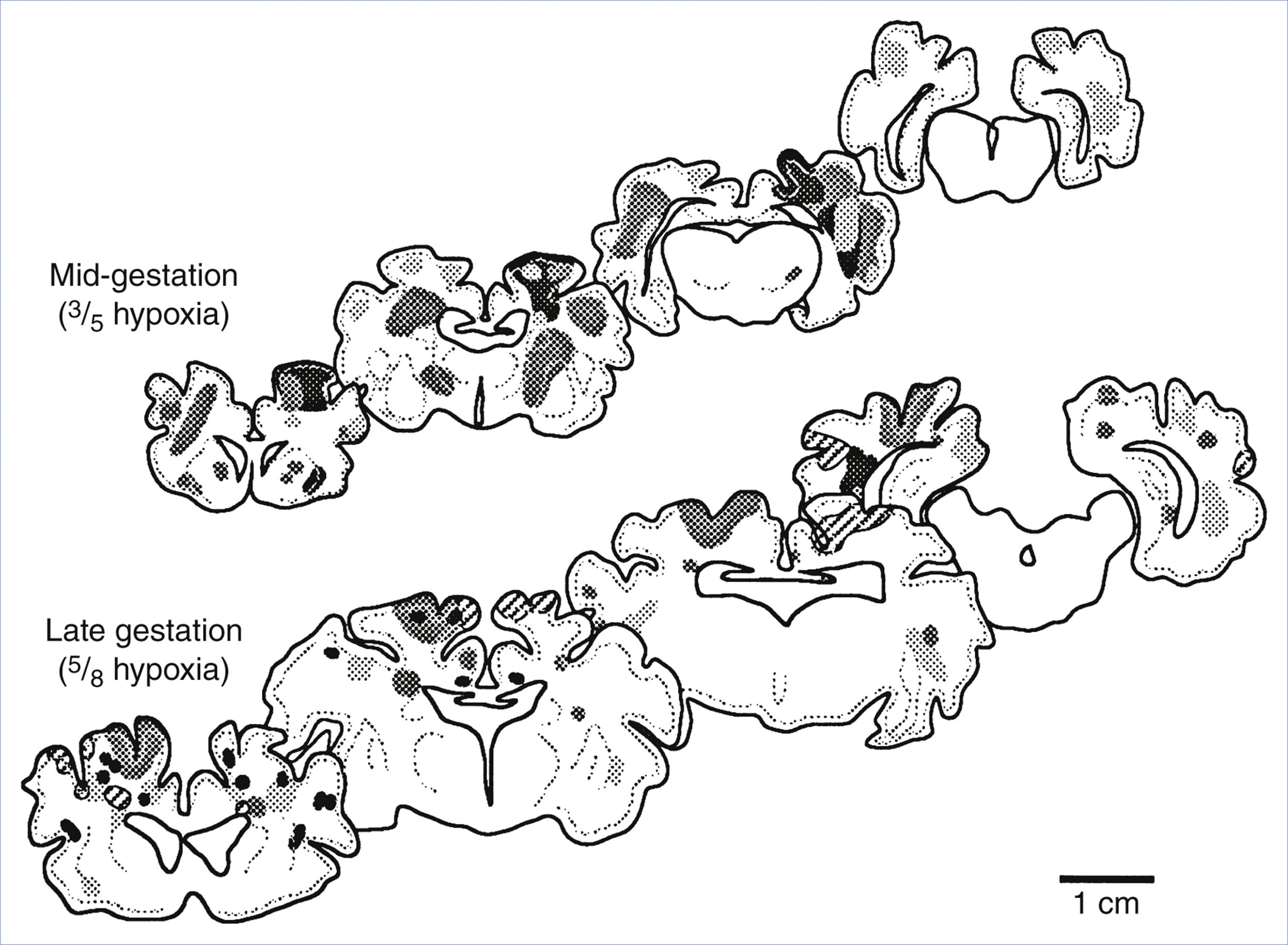 A composite diagram shows brain cross-sections from fetal lambs at mid and late gestation with regions of hypoxic injury.