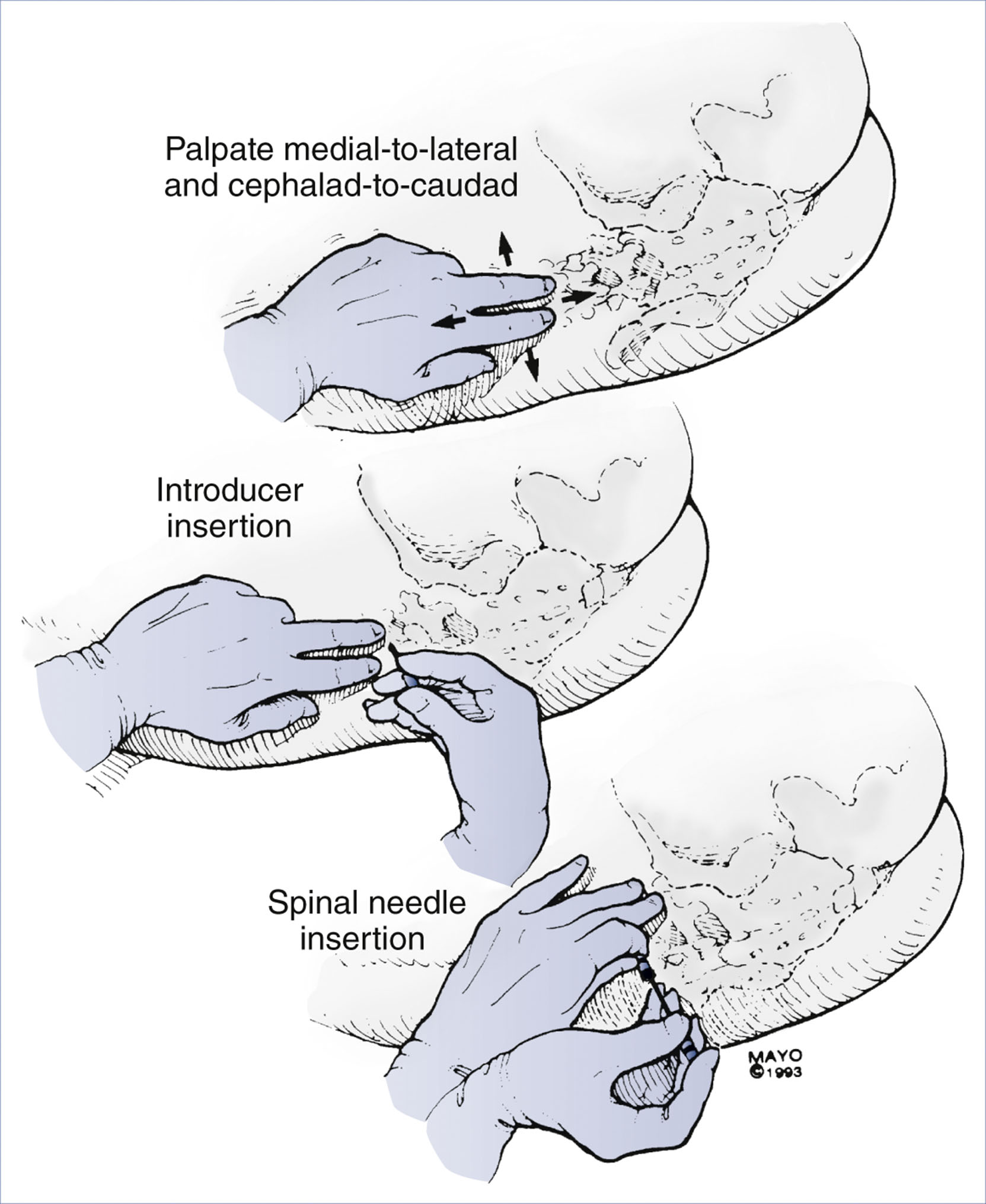An anatomical diagram presents three steps of spinal needle insertion using the midline approach.