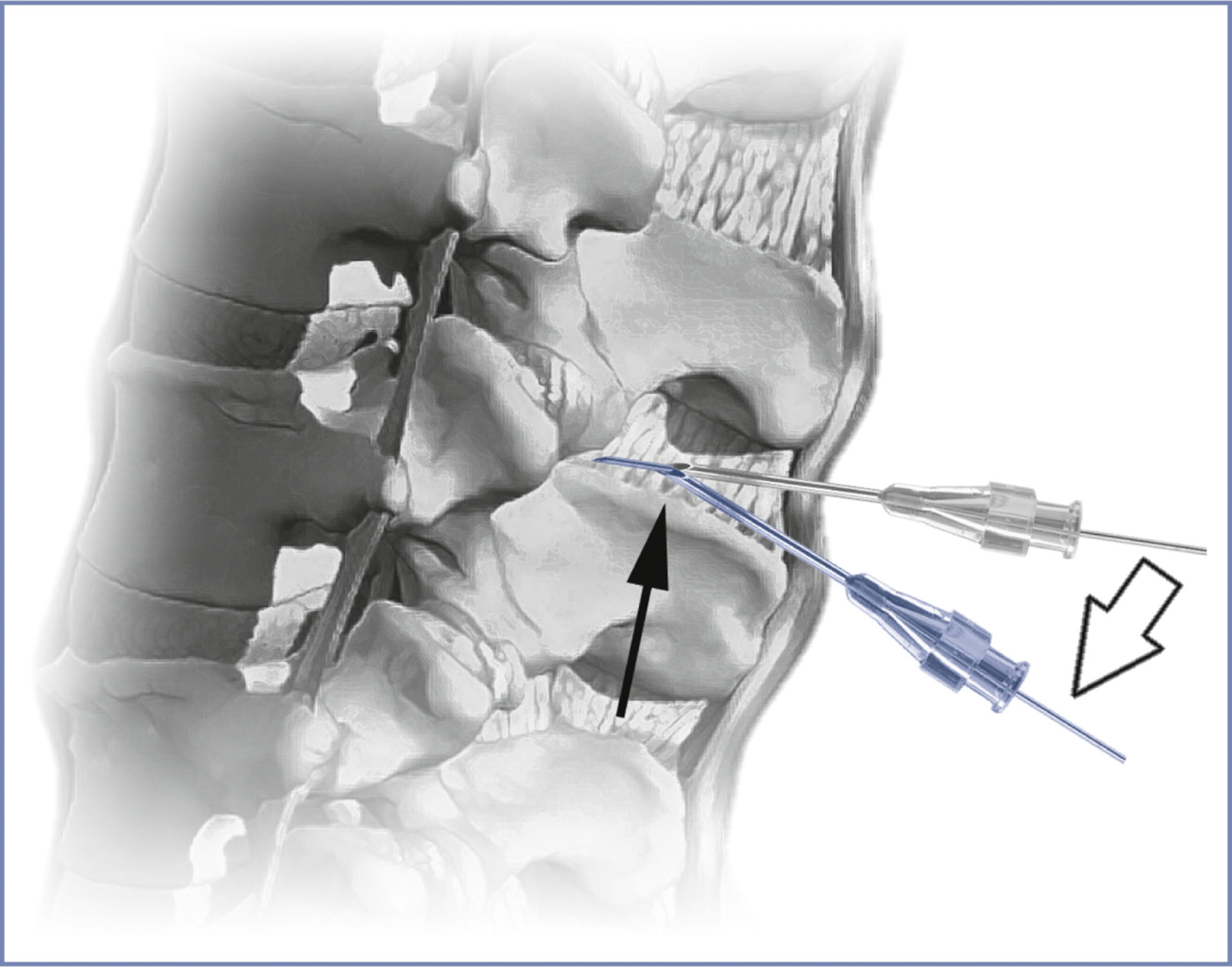 An anatomical diagram presents a spinal needle and introducer inserted through the lumbar vertebrae with indicated trajectory change.