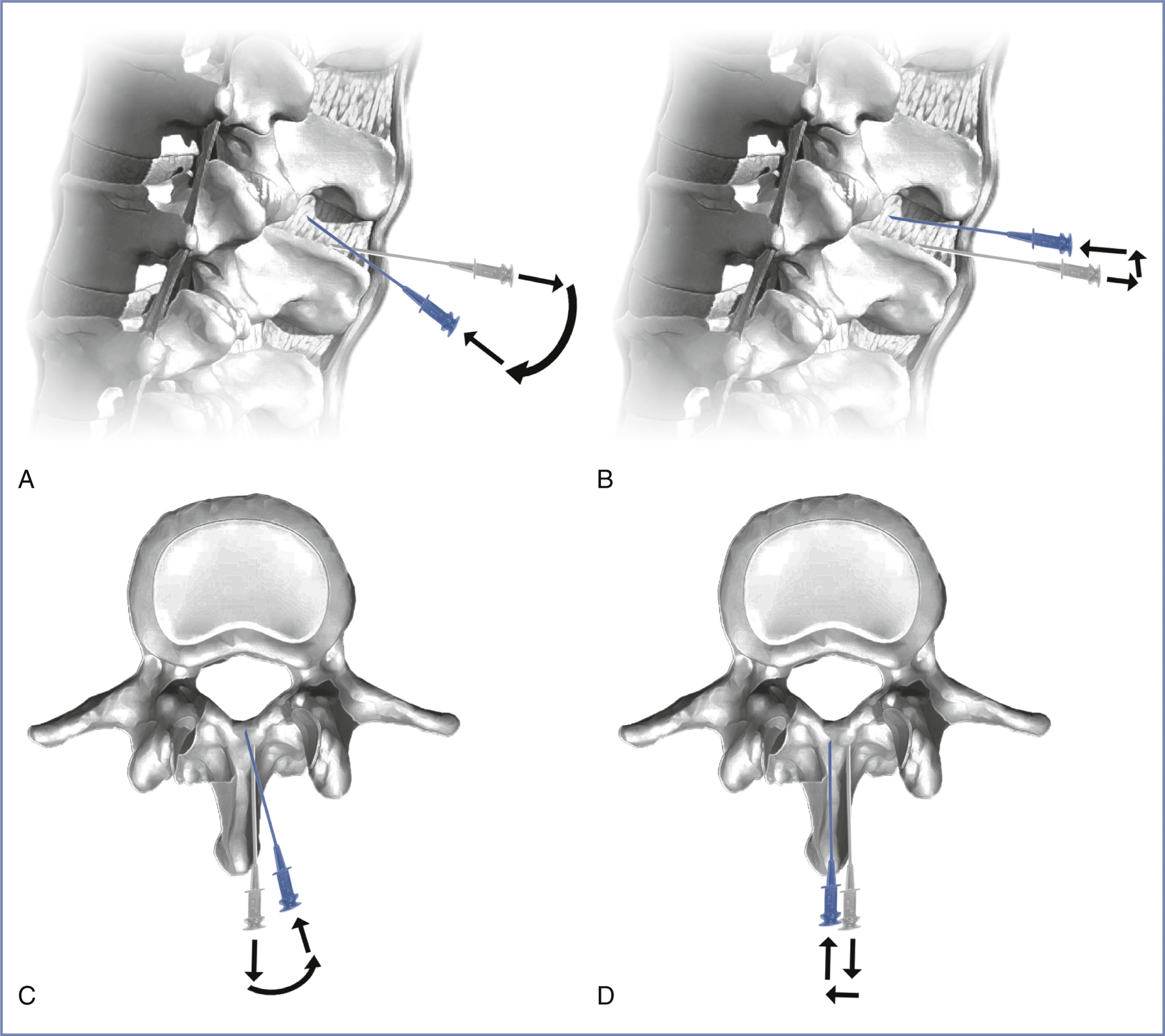 A set of four instructional medical diagrams presents techniques for adjusting the spinal needle trajectory during bone contact.