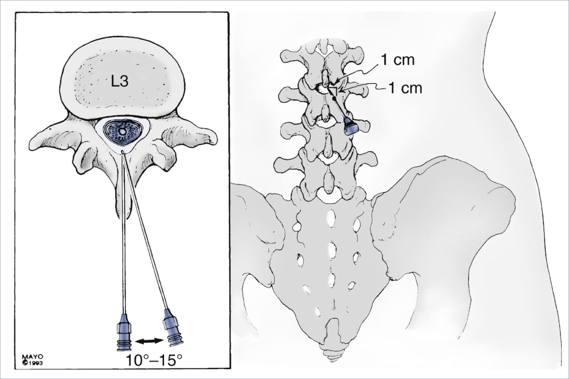 An anatomical diagram presents midline and paramedian approaches for spinal and epidural anesthesia.