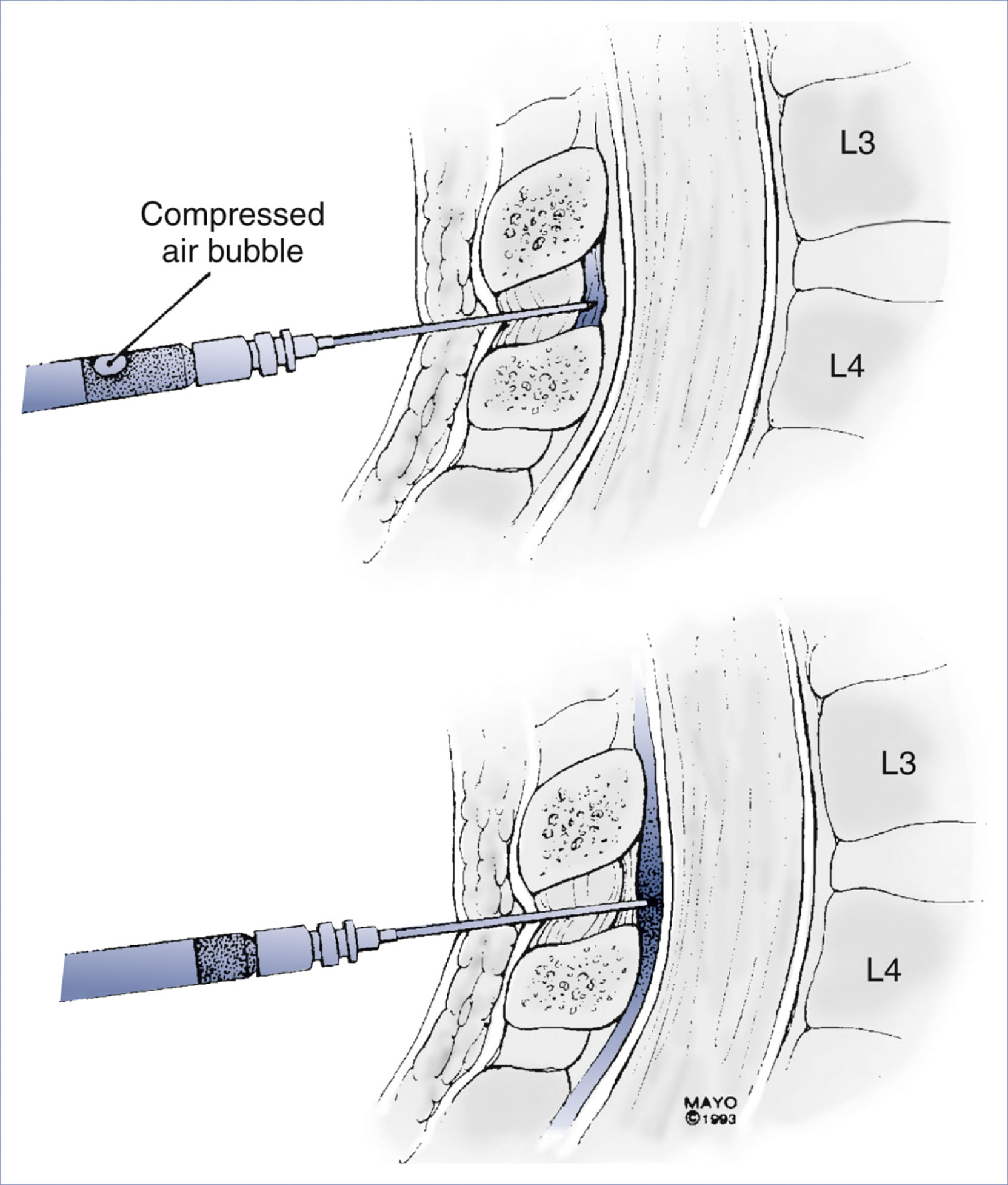An anatomical diagram presents two steps of the loss of resistance technique for identifying the epidural space.
