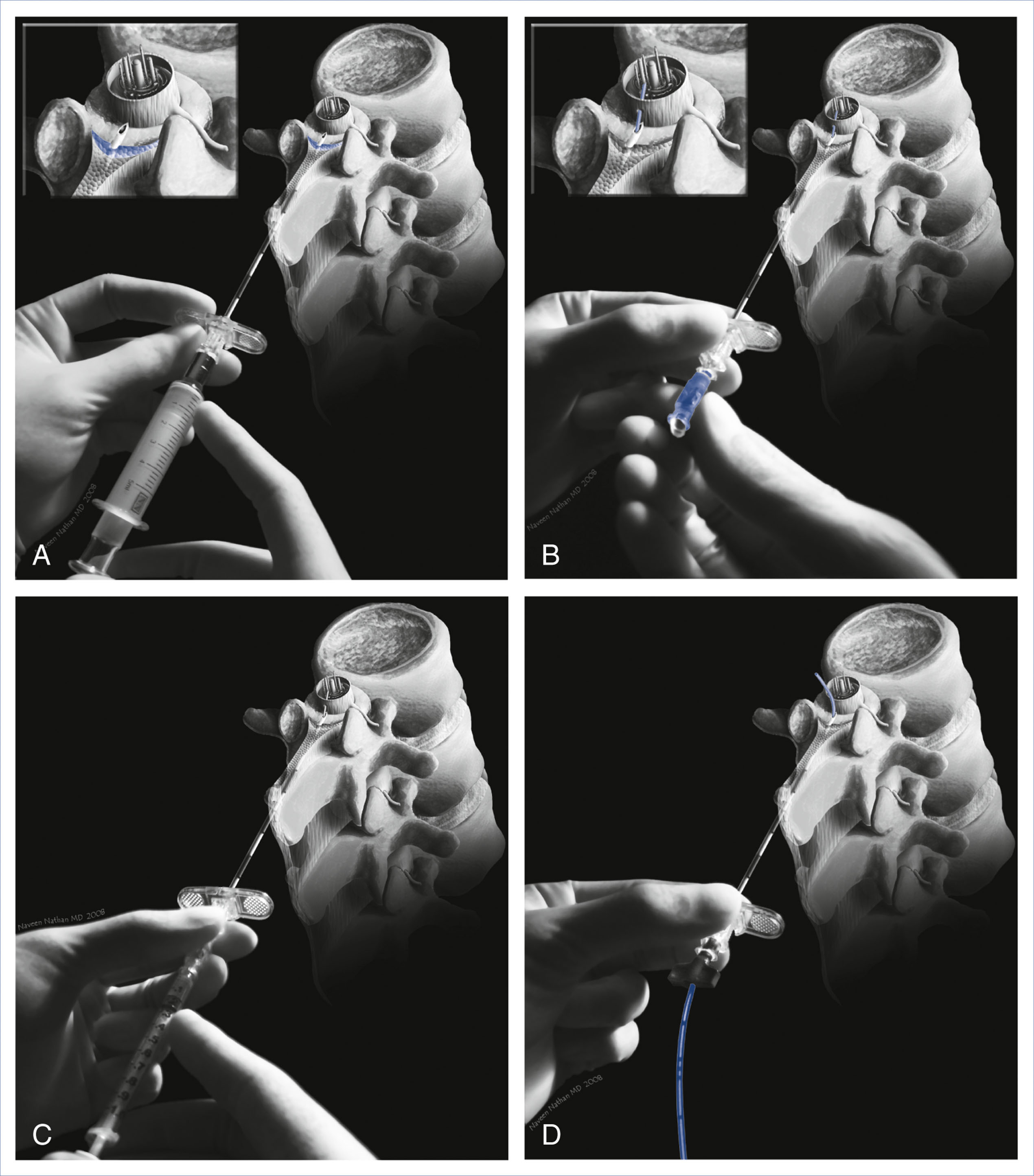 A procedural medical diagram presents four steps of the needle through needle combined spinal epidural technique.