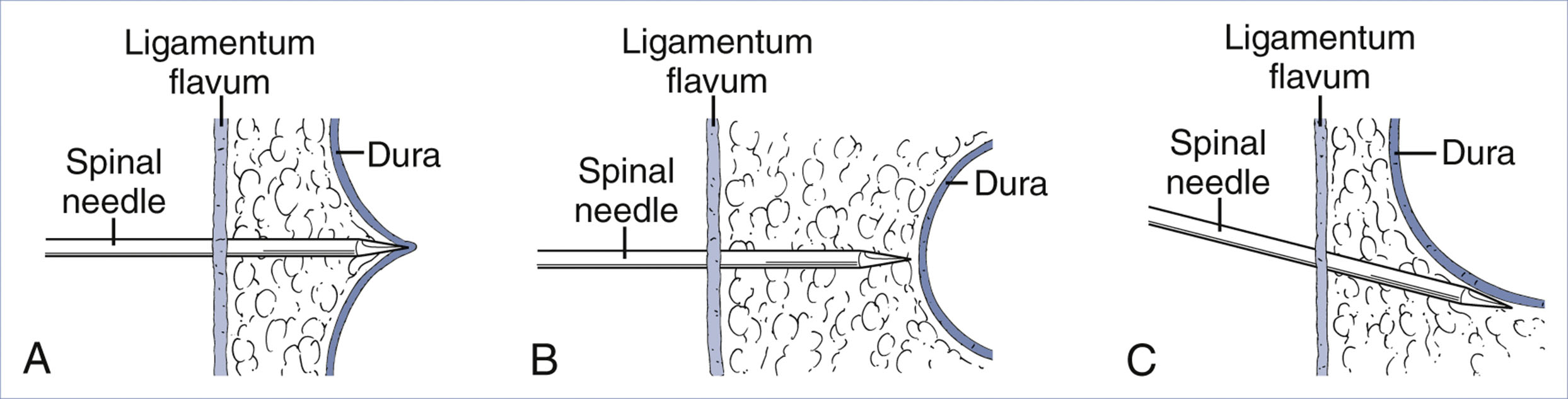 A medical diagram presents three causes of failure in the combined spinal epidural technique using spinal needles.