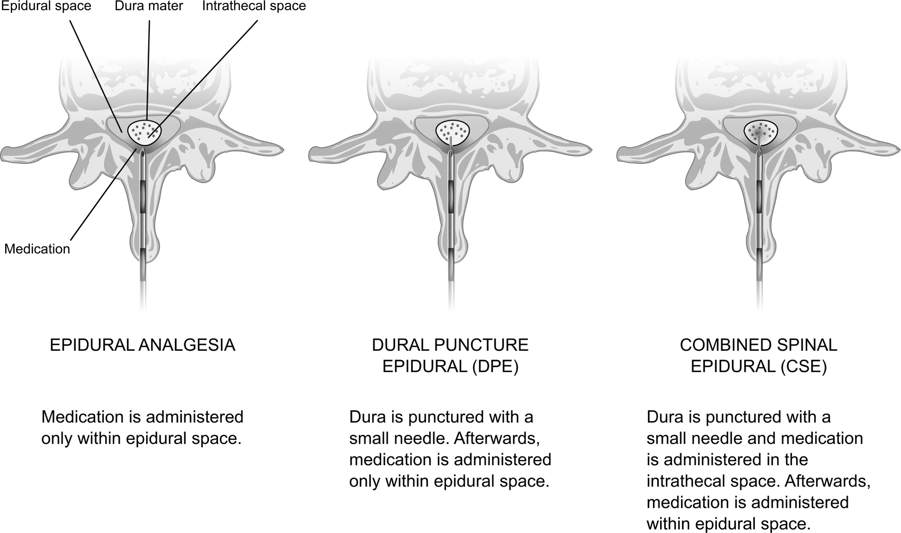 A medical illustration presents three neuraxial analgesia techniques, showing epidural, dural puncture epidural, and combined spinal epidural approaches.