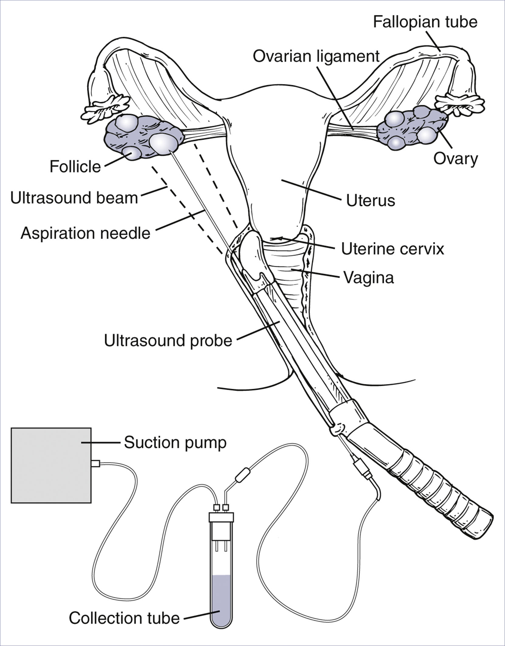 An illustration depicts transvaginal ultrasound guided oocyte retrieval with labeled uterus, ovaries, follicles, probe, aspiration needle, and +collection system.