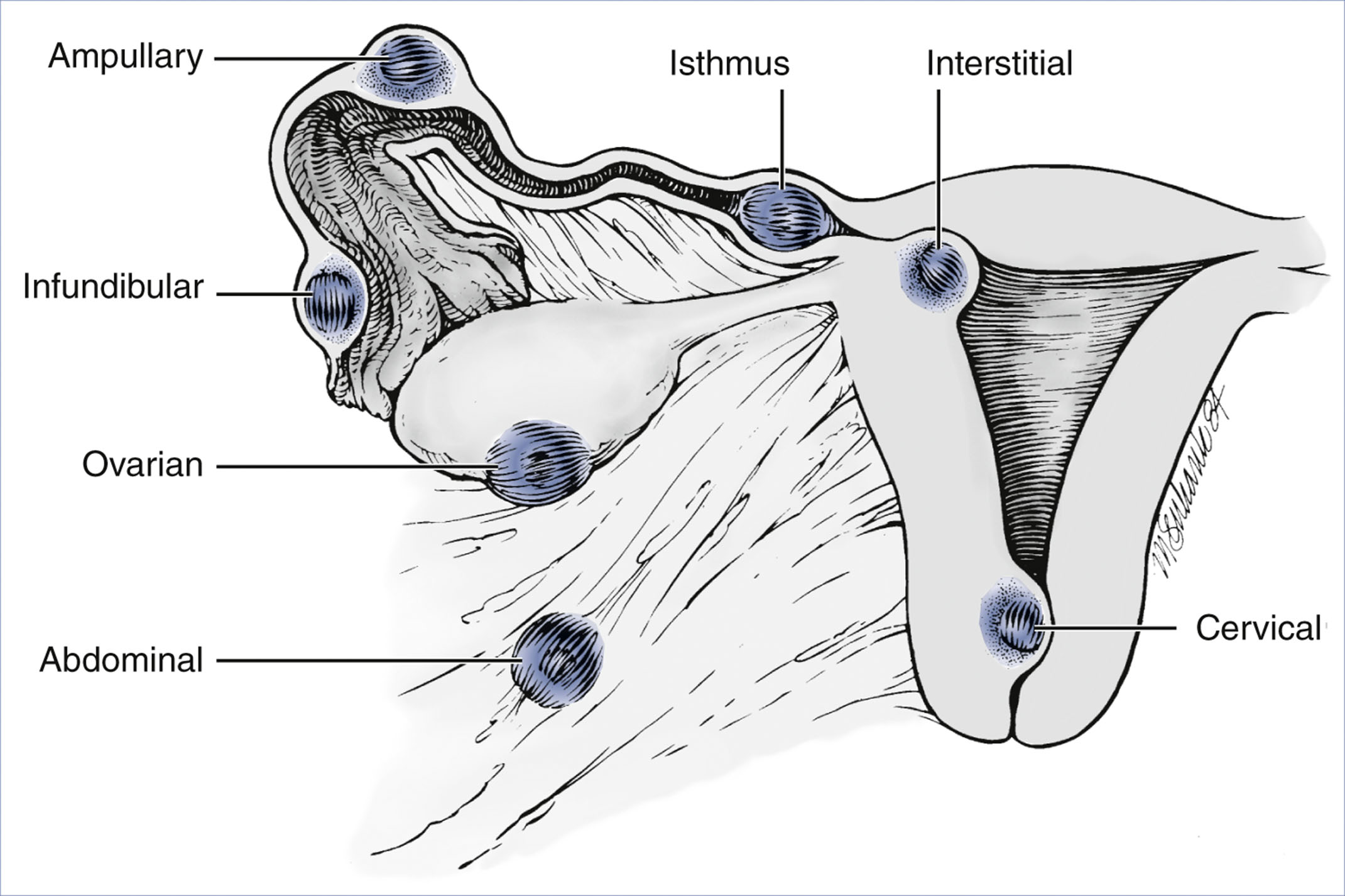An anatomical diagram labels potential ectopic pregnancy sites, including ampullary, isthmus, interstitial, infundibular, ovarian, abdominal, and cervical regions.