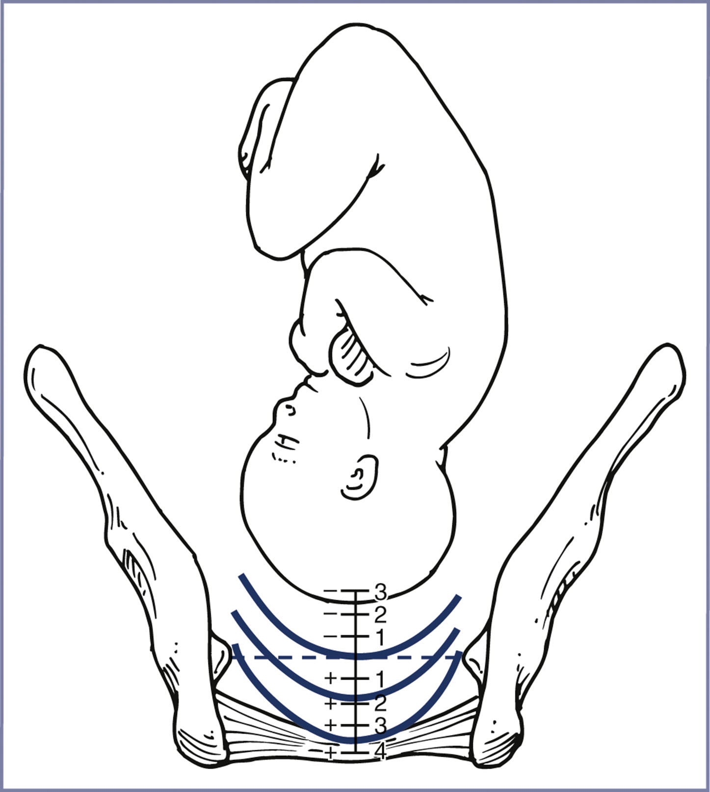 An illustration shows fetal head descent relative to the maternal pelvis with curved reference lines labeled from plus 3 to minus 4 across vertical station markings.