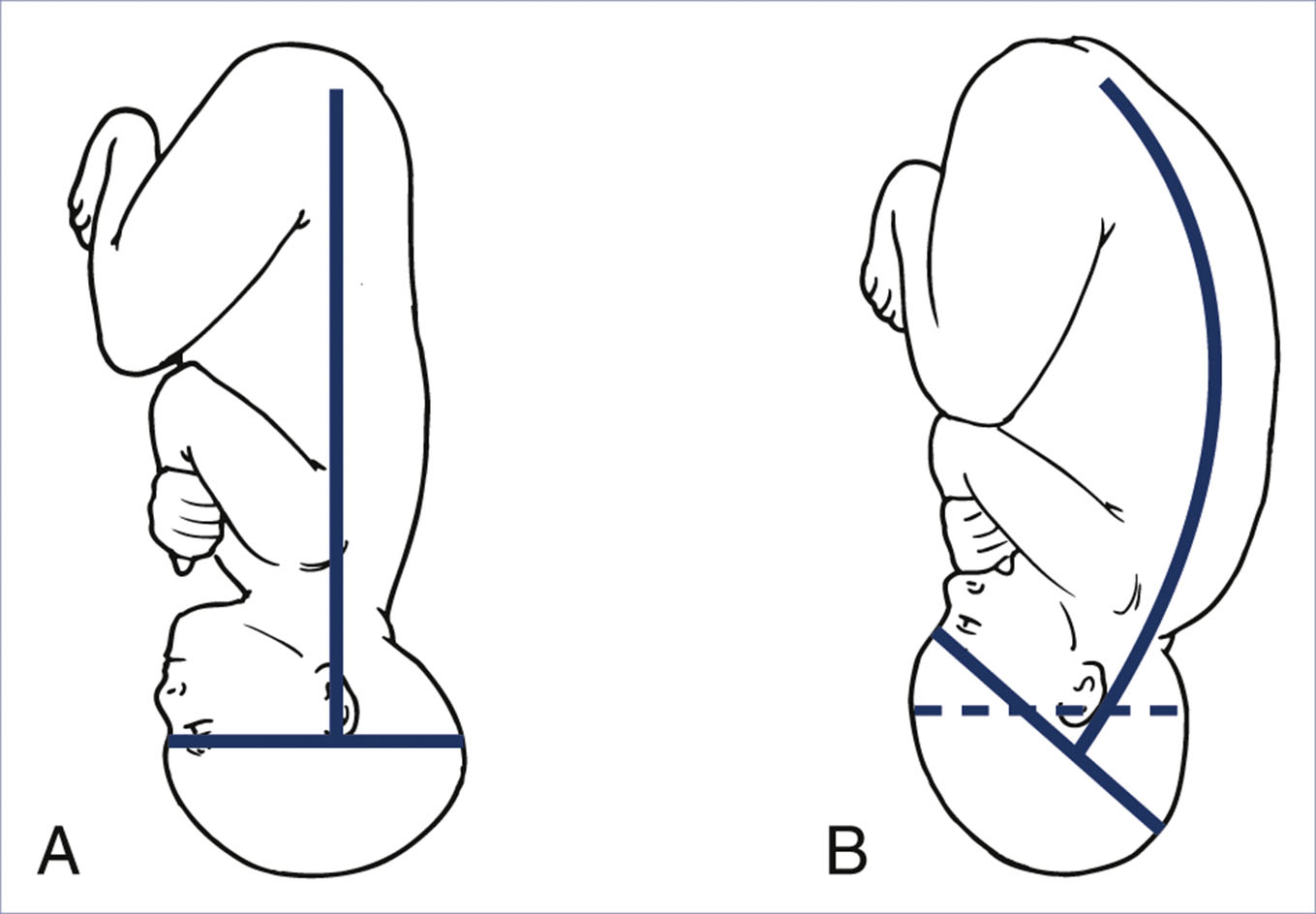 An illustration shows a fetus with a straight spine and extended head in panel A, and a curved spine with a flexed head and chin to chest in panel B, using reference lines.