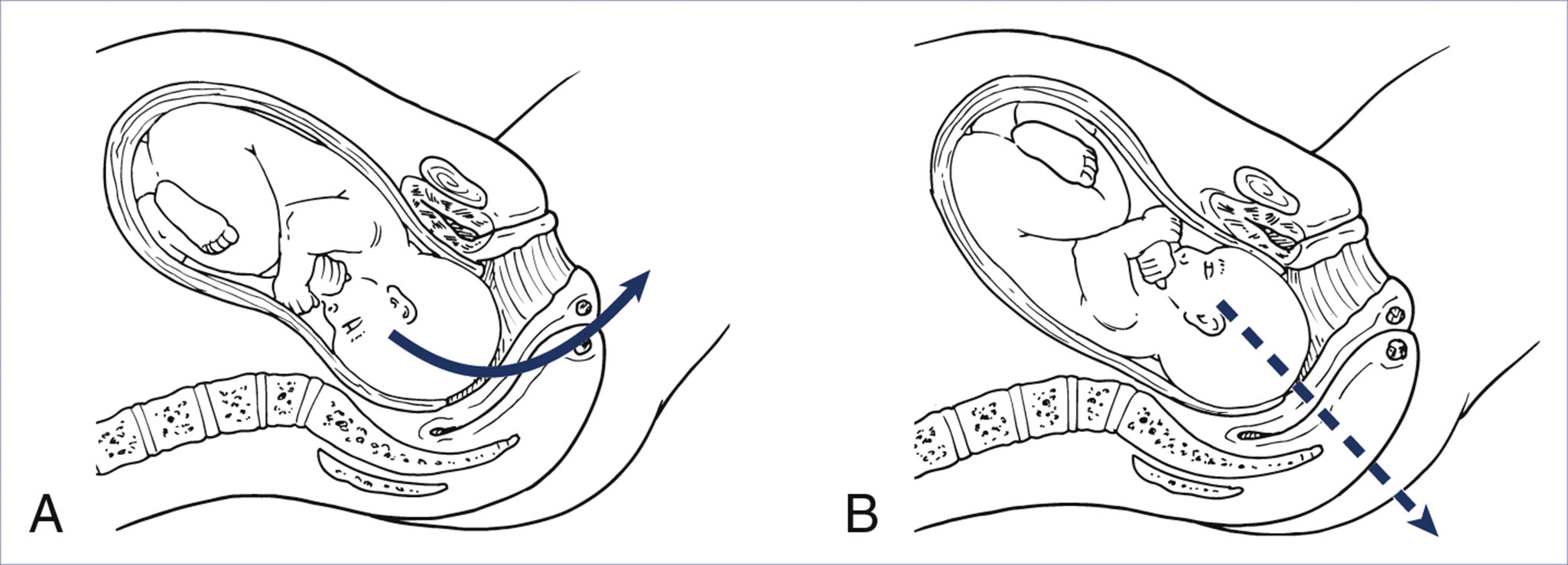An illustration shows fetal position in vertex presentation with occiput anterior in panel A and occiput posterior in panel B using curved and angled arrows.