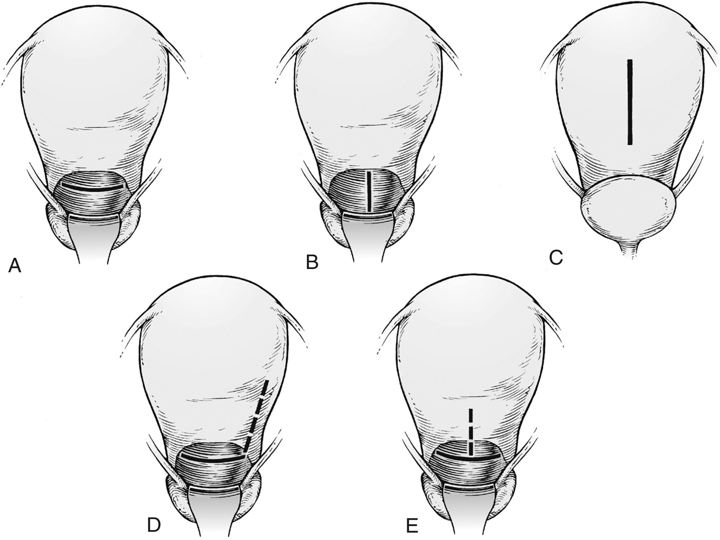 An illustration shows five types of uterine incisions for cesarean delivery, including low transverse, low vertical, classic, J-shaped, and T-shaped.