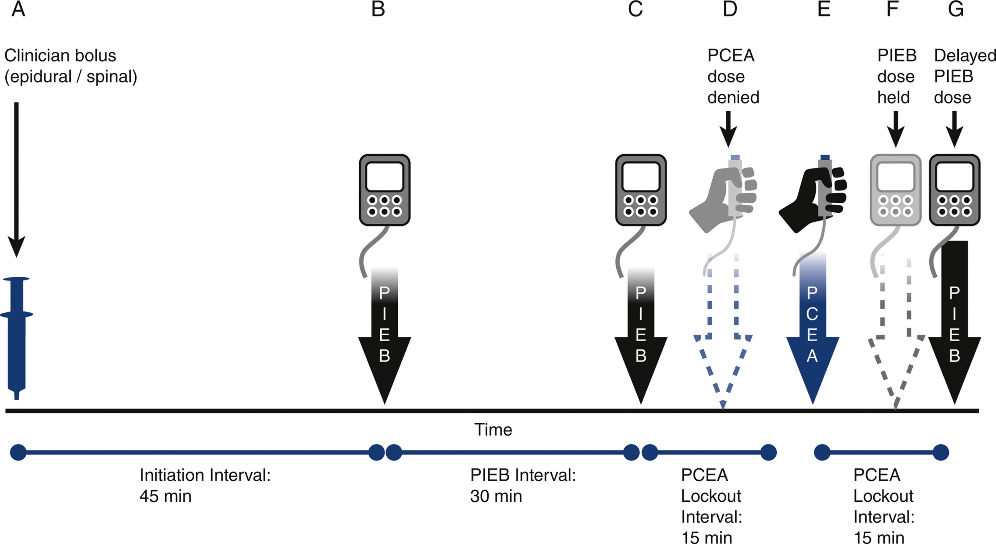 A schematic timeline illustrates programmed intermittent epidural bolus and patient-controlled epidural analgesia with labeled events A to G.