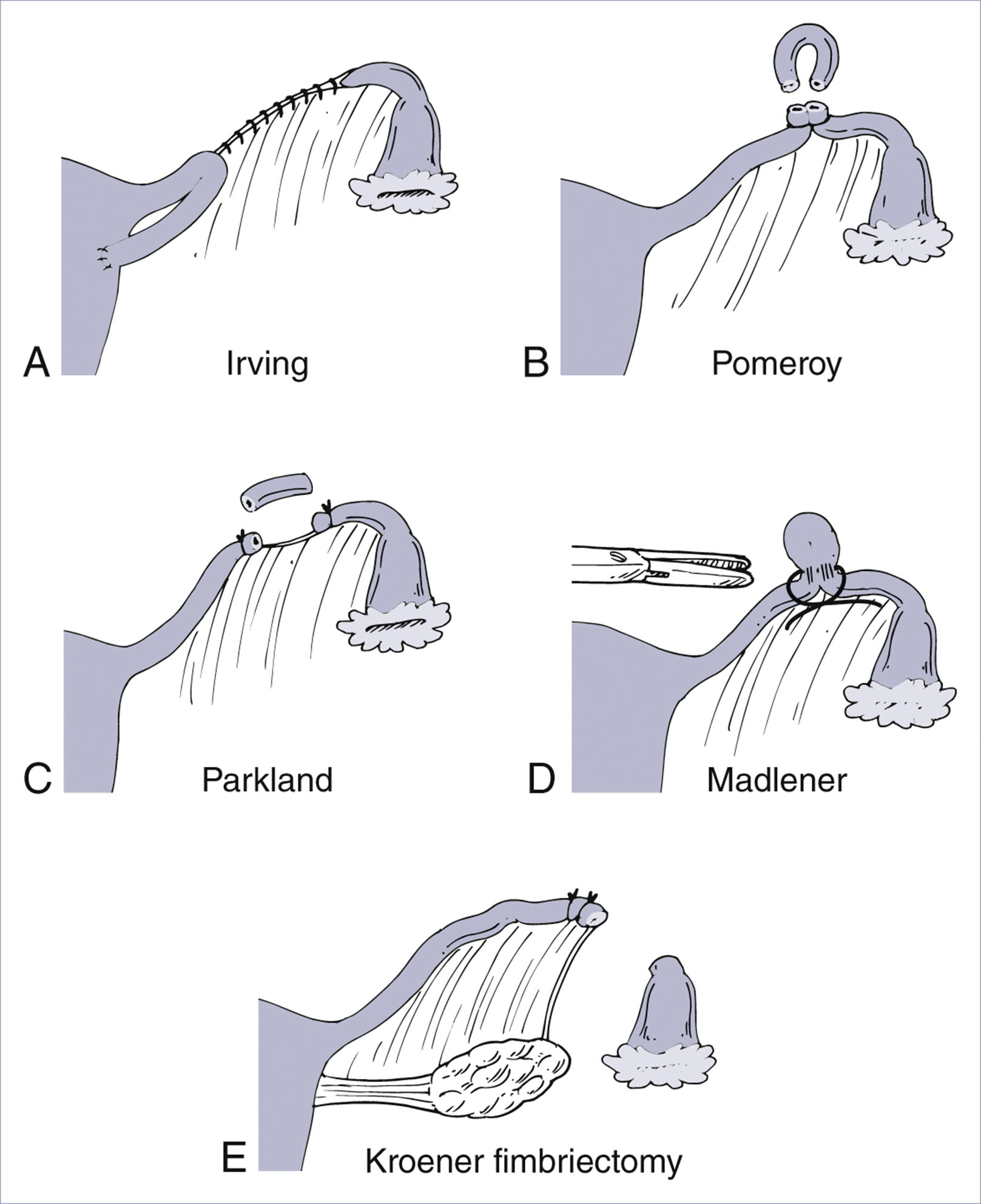 An illustration compares five labeled tubal sterilization techniques, including Irving, Pomeroy, Parkland, Madlener, and Kroener fimbriectomy.