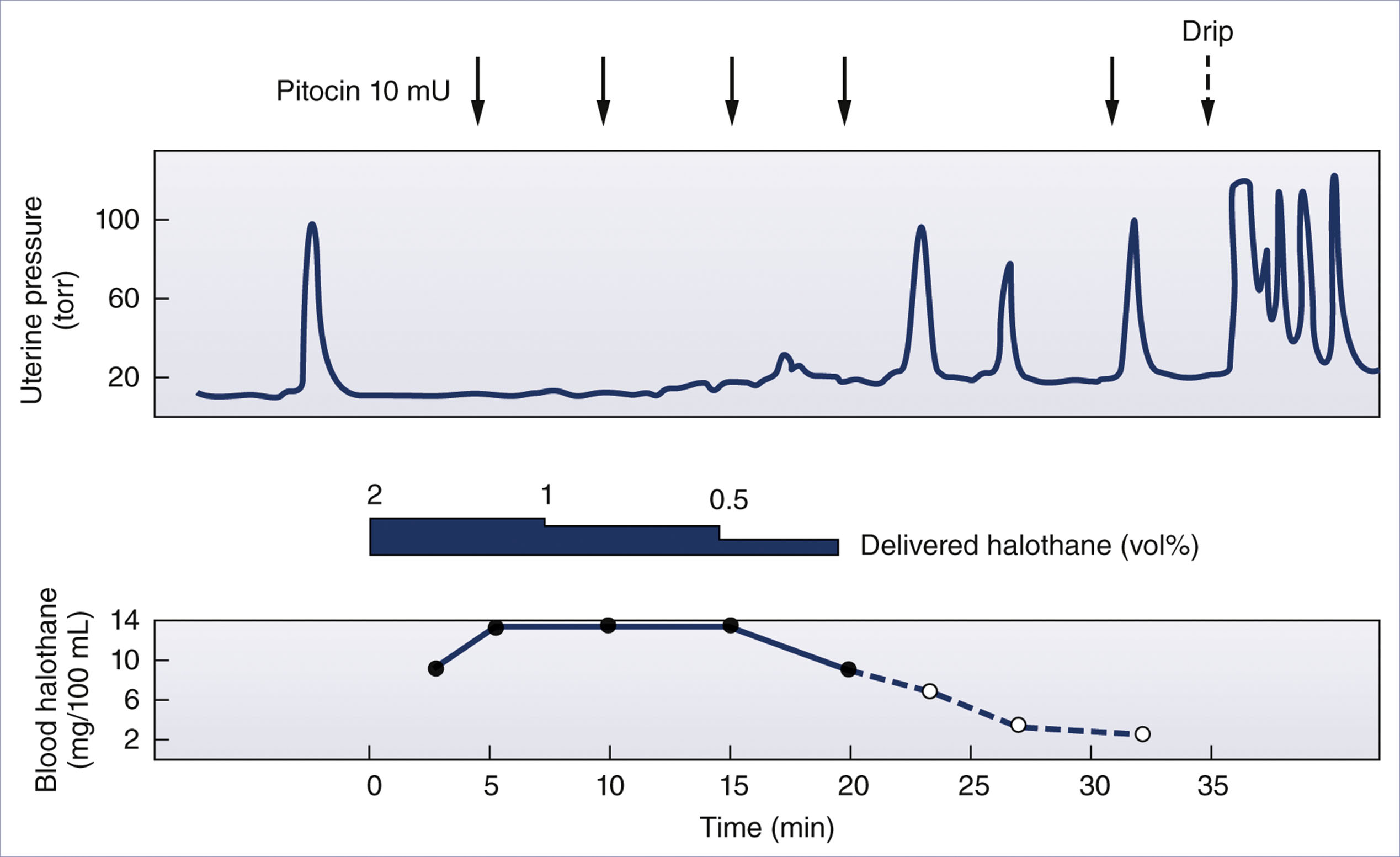 A two-part graph shows uterine pressure and blood halothane level over time, with labeled halothane doses and Pitocin administration.