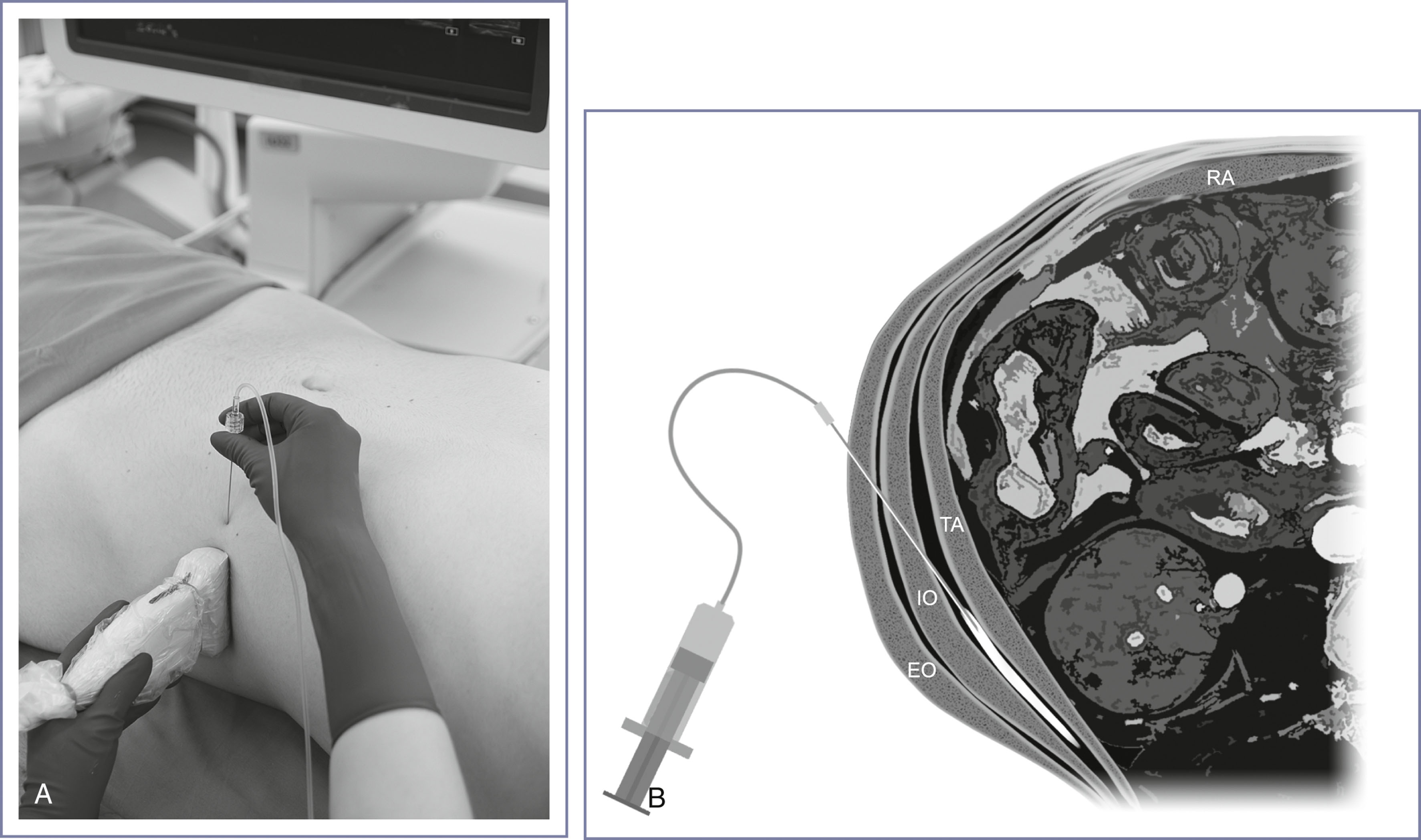 A paired view shows an ultrasound-guided abdominal injection and an illustration of needle placement between abdominal muscles.