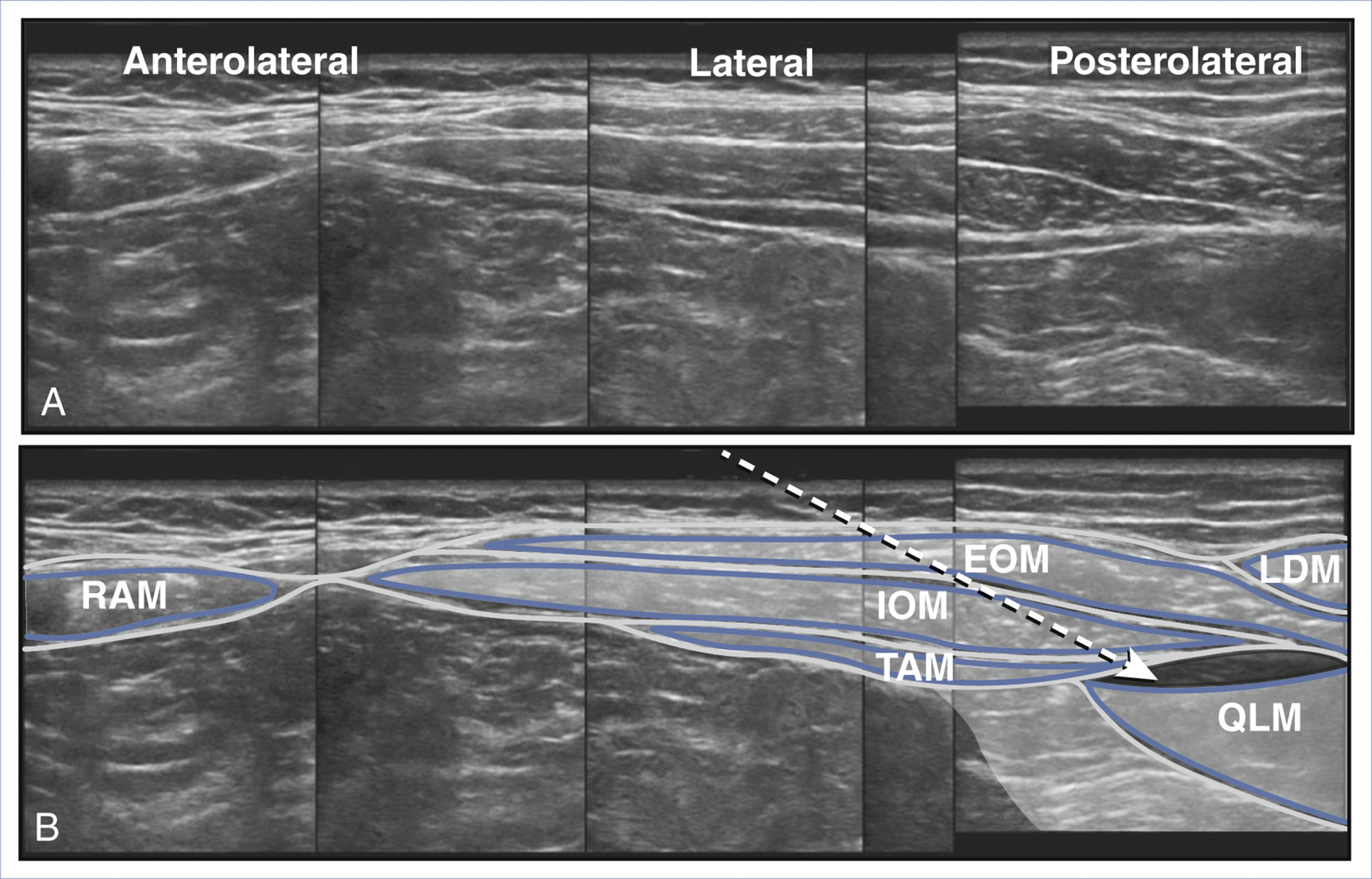 A paired view shows ultrasound sections of abdominal muscles and a labeled diagram illustrating quadratus lumborum block needle placement.
