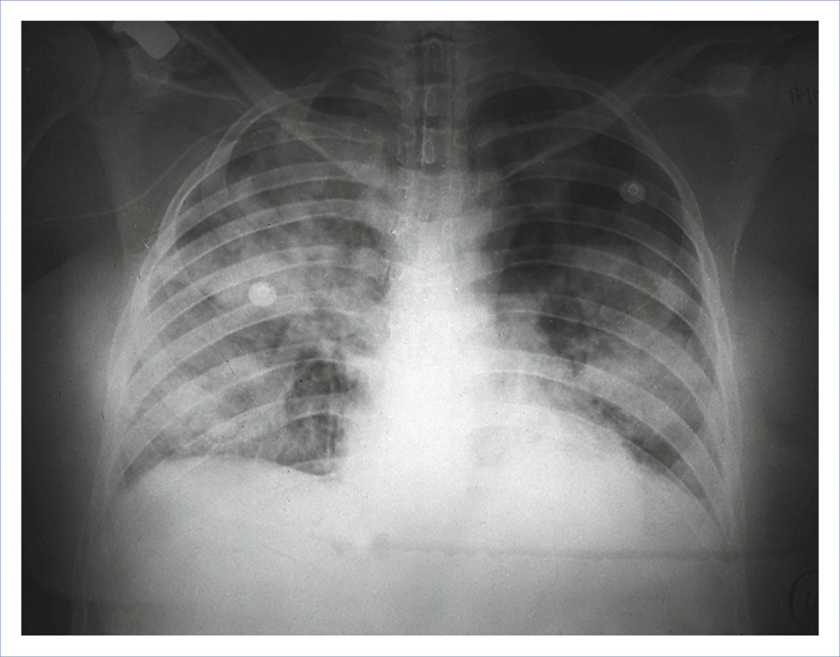 A chest radiograph shows bilateral lung opacities following pulmonary aspiration in pregnancy.