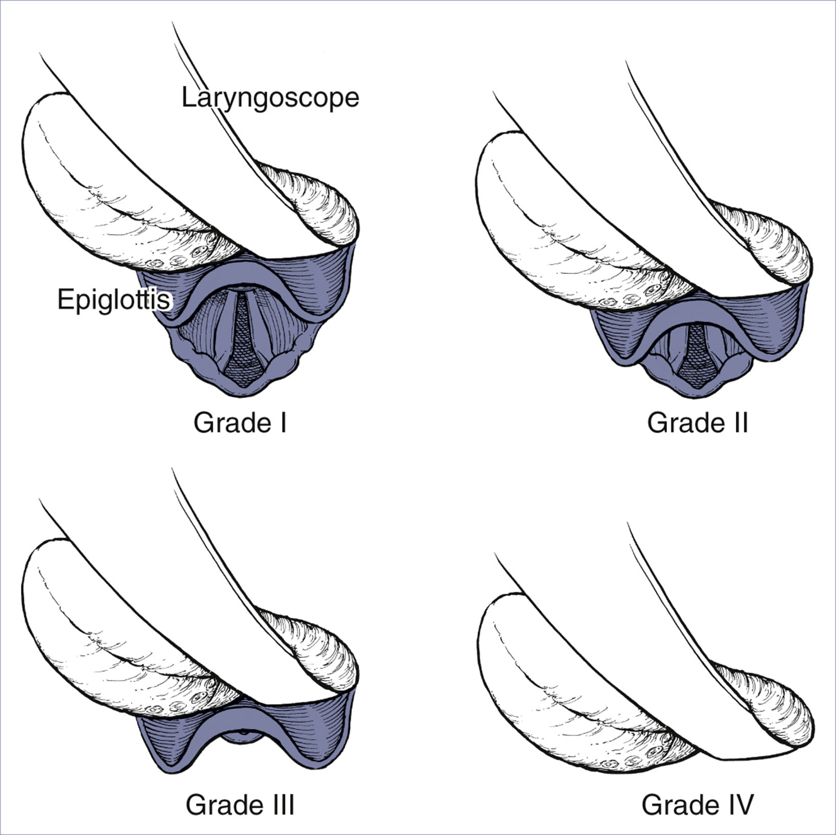 A set of four diagrams shows laryngoscopic views labeled Grade one to Grade four with decreasing visibility of airway structures.