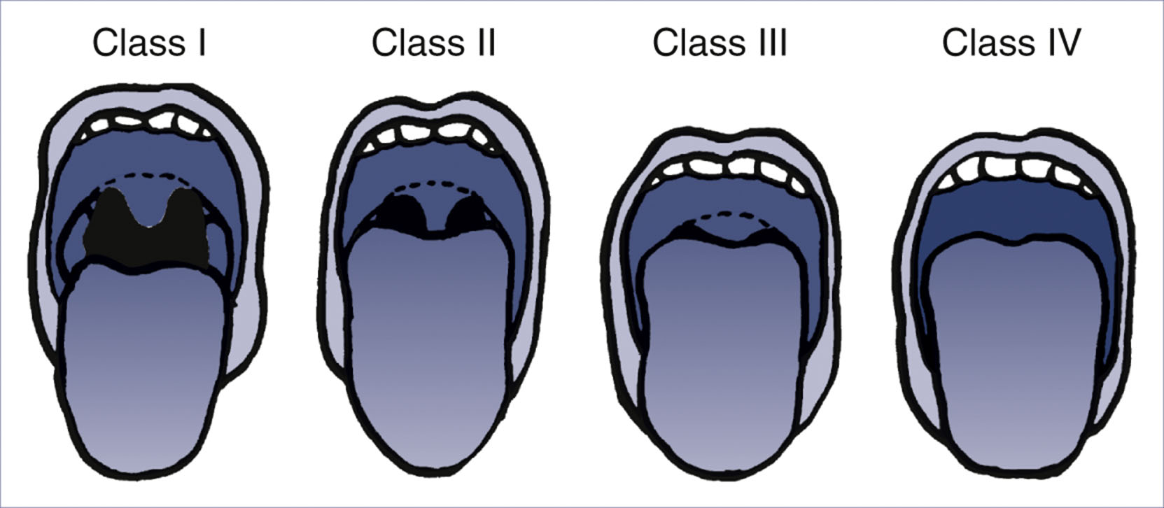 A set of four diagrams shows an open mouth labeled Class One to Class Four with varying visibility of oropharyngeal structures.