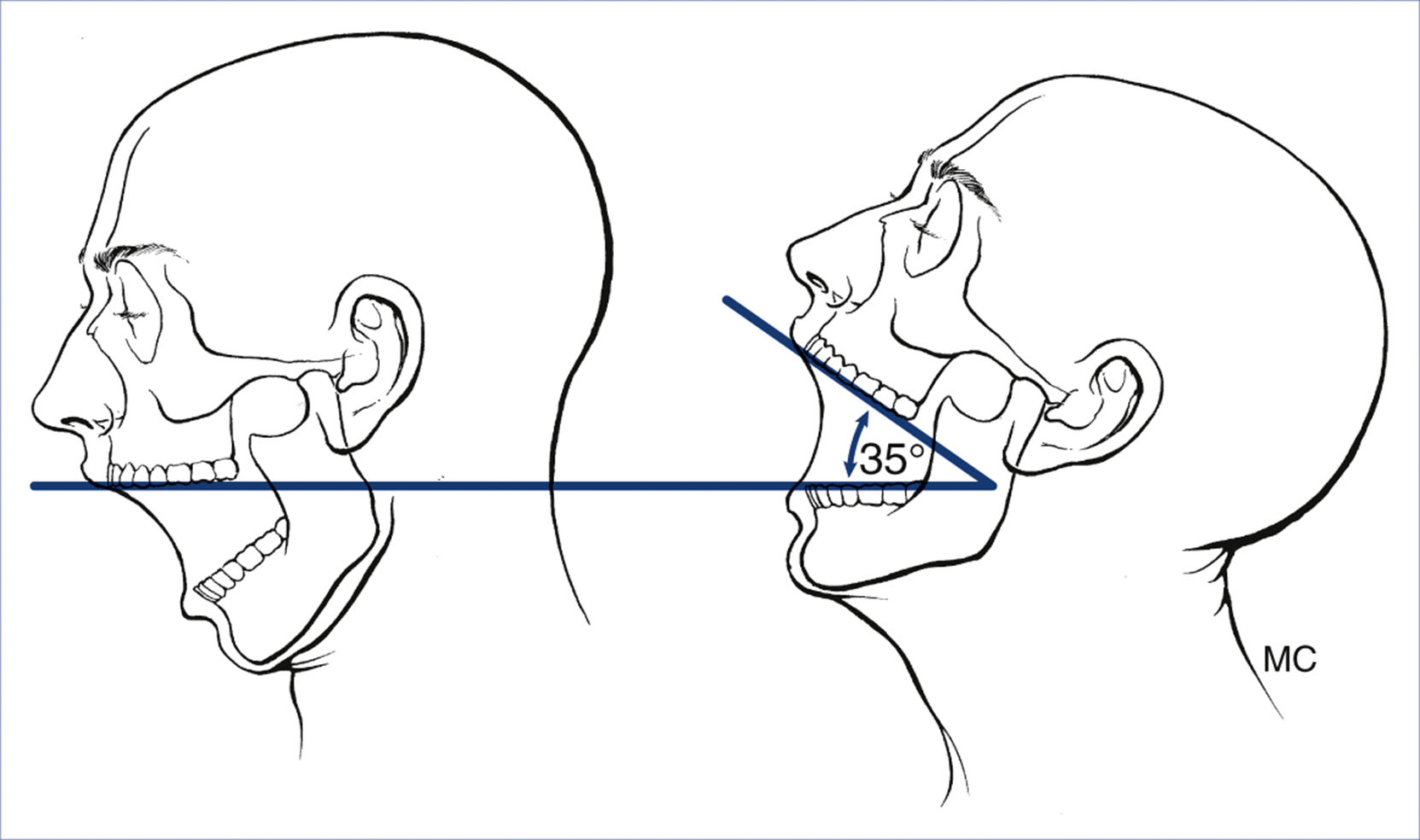A pair of side-view head diagrams shows the mouth opening with a measured angle of thirty-five degrees during extension.