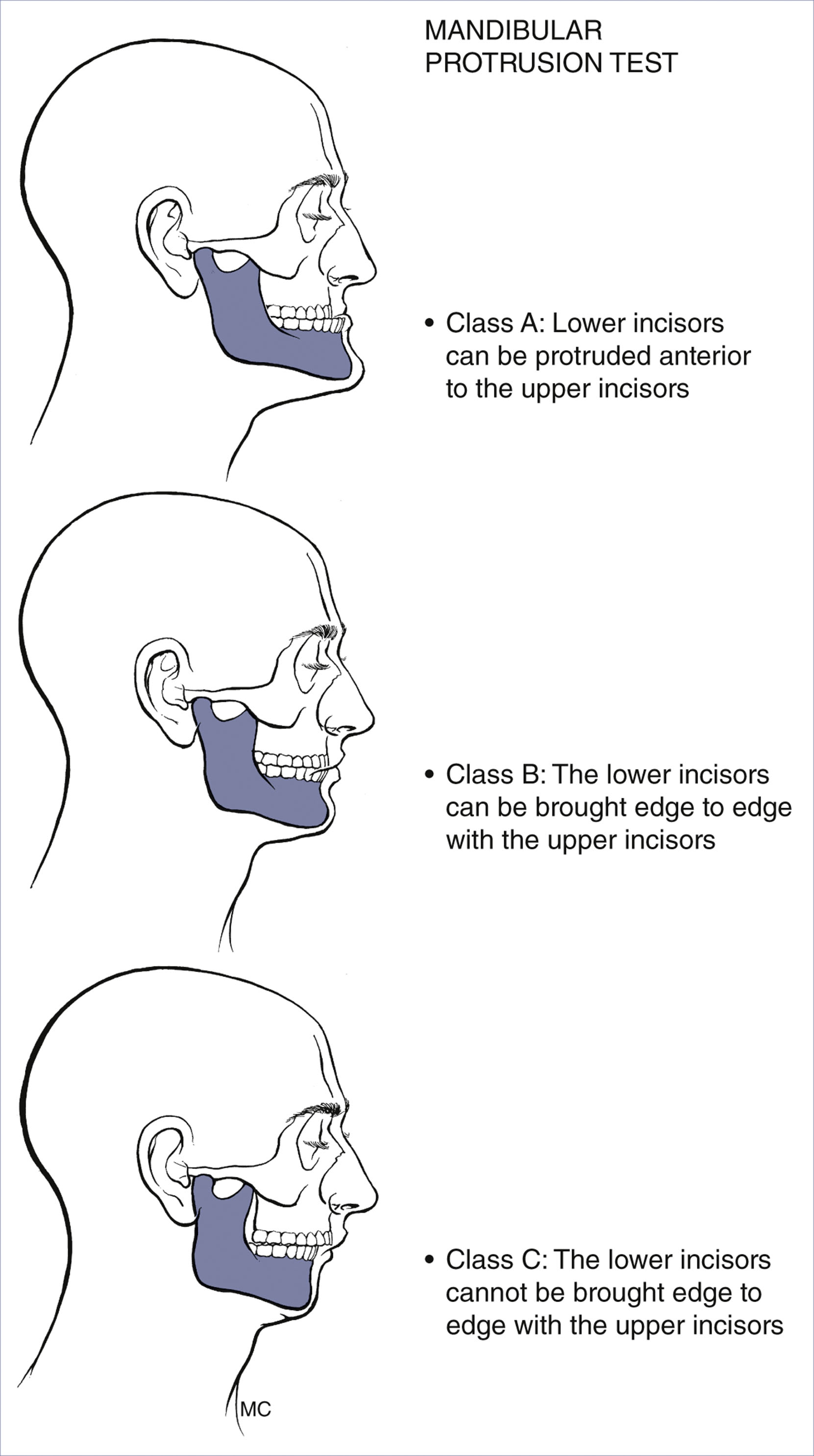 A set of three side-view head diagrams shows mandibular protrusion test results labeled Class A to Class C.