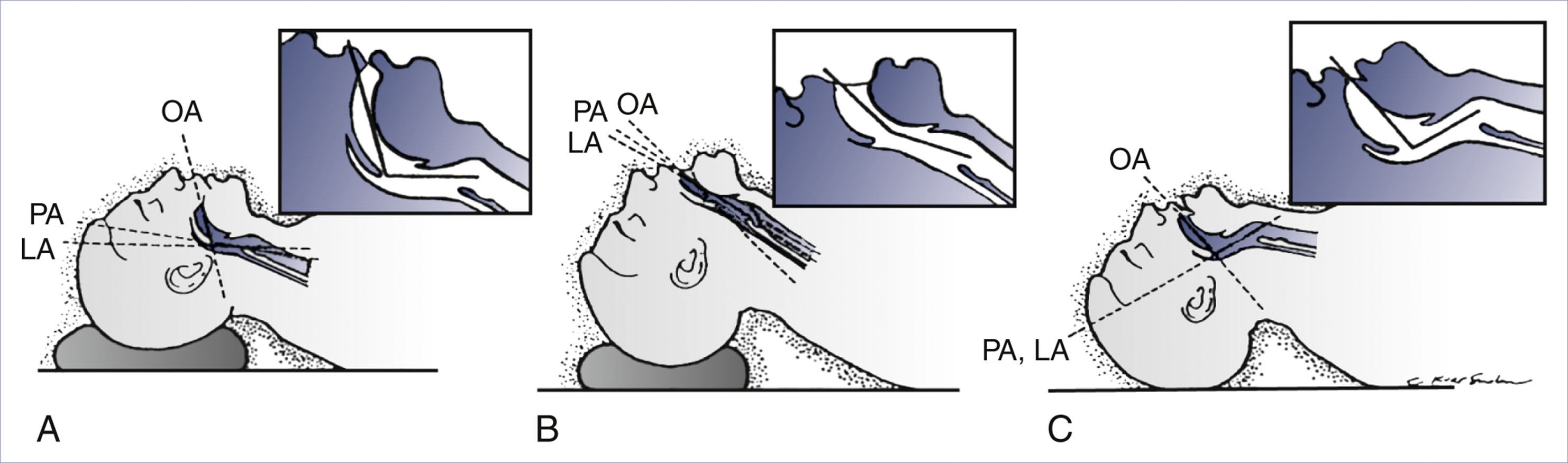 A set of three side-view diagrams labeled A to C, which shows head and neck positions with oral, pharyngeal, and laryngeal axis alignment during laryngoscopy.