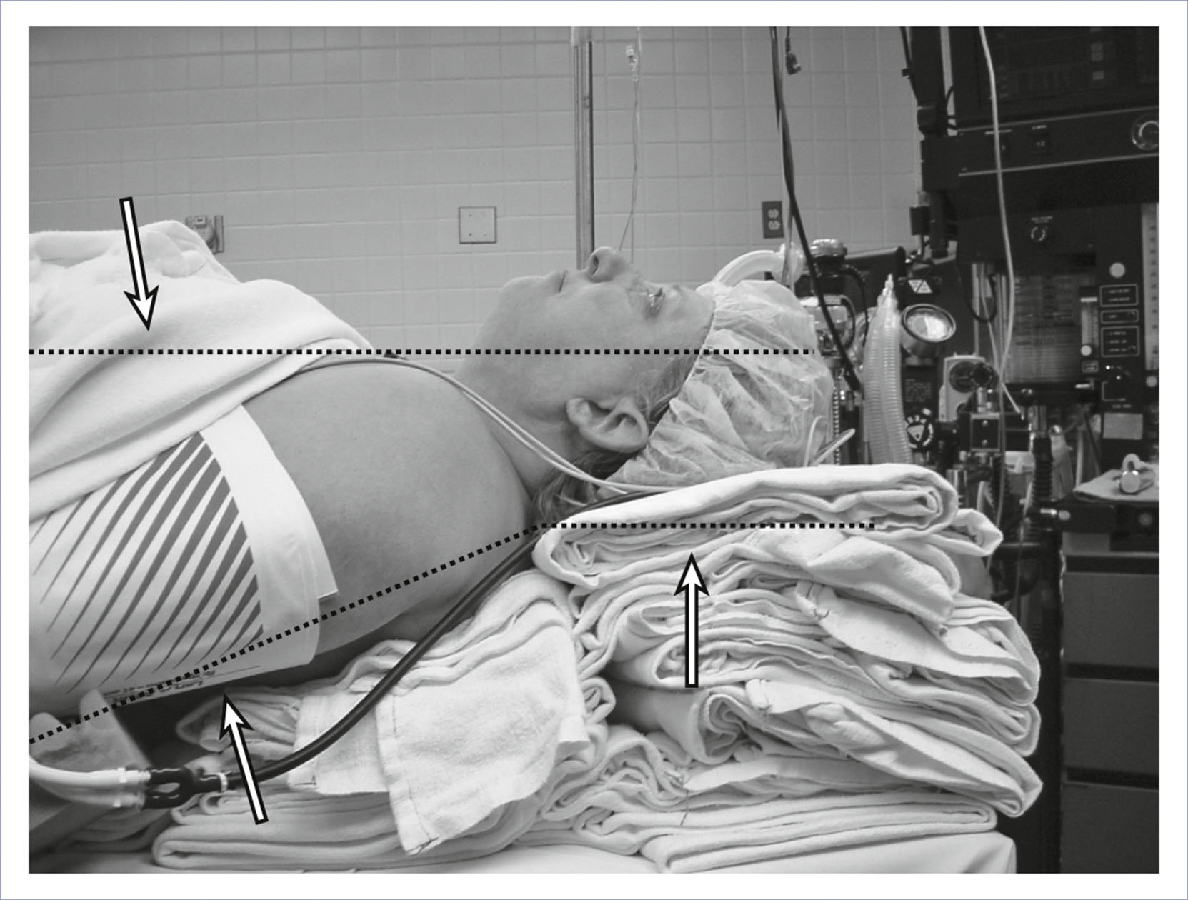 A photograph shows a patient lying on an operating table with the head and upper body elevated using stacked blankets, with alignment arrows marking airway positioning.