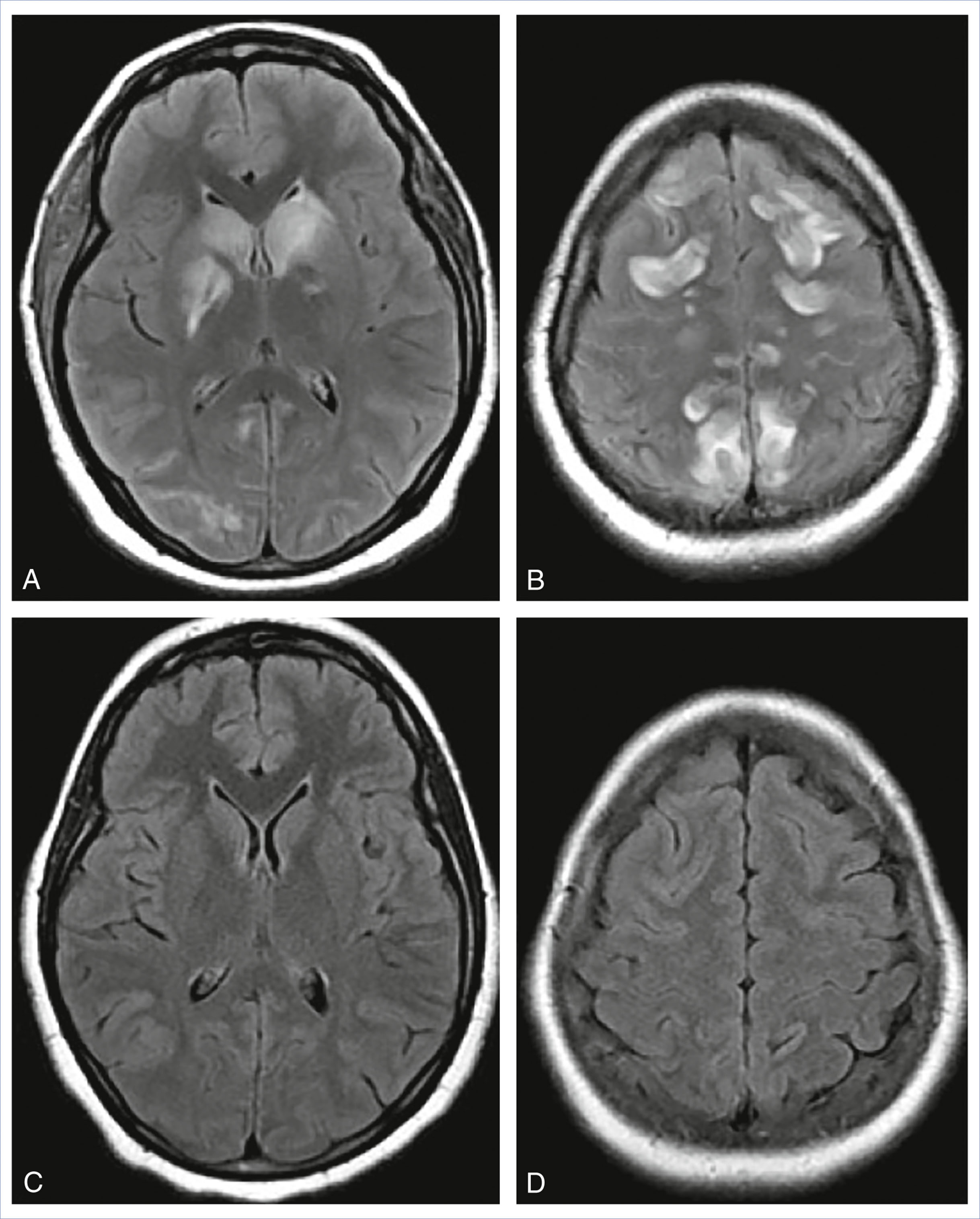 A set of four axial brain M R scans shows vasogenic edema in a patient with posterior reversible encephalopathy syndrome before and after treatment.