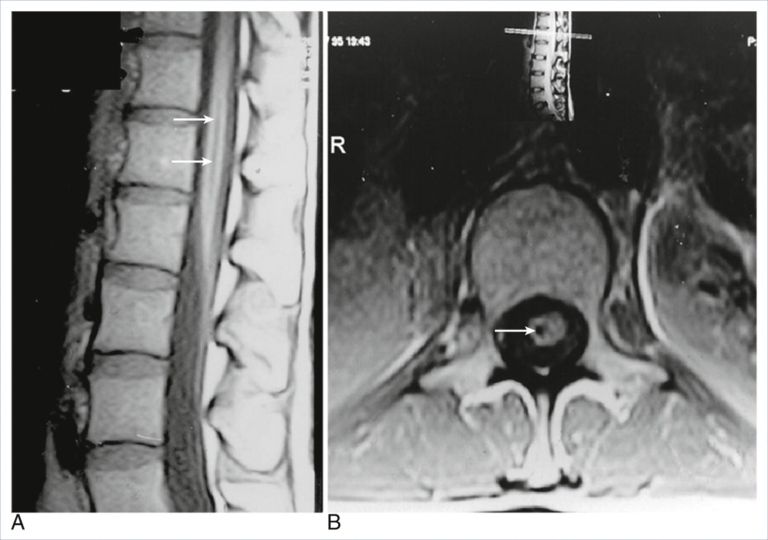 A sagittal and axial magnetic resonance scan shows a conus medullaris lesion indicated by arrows.