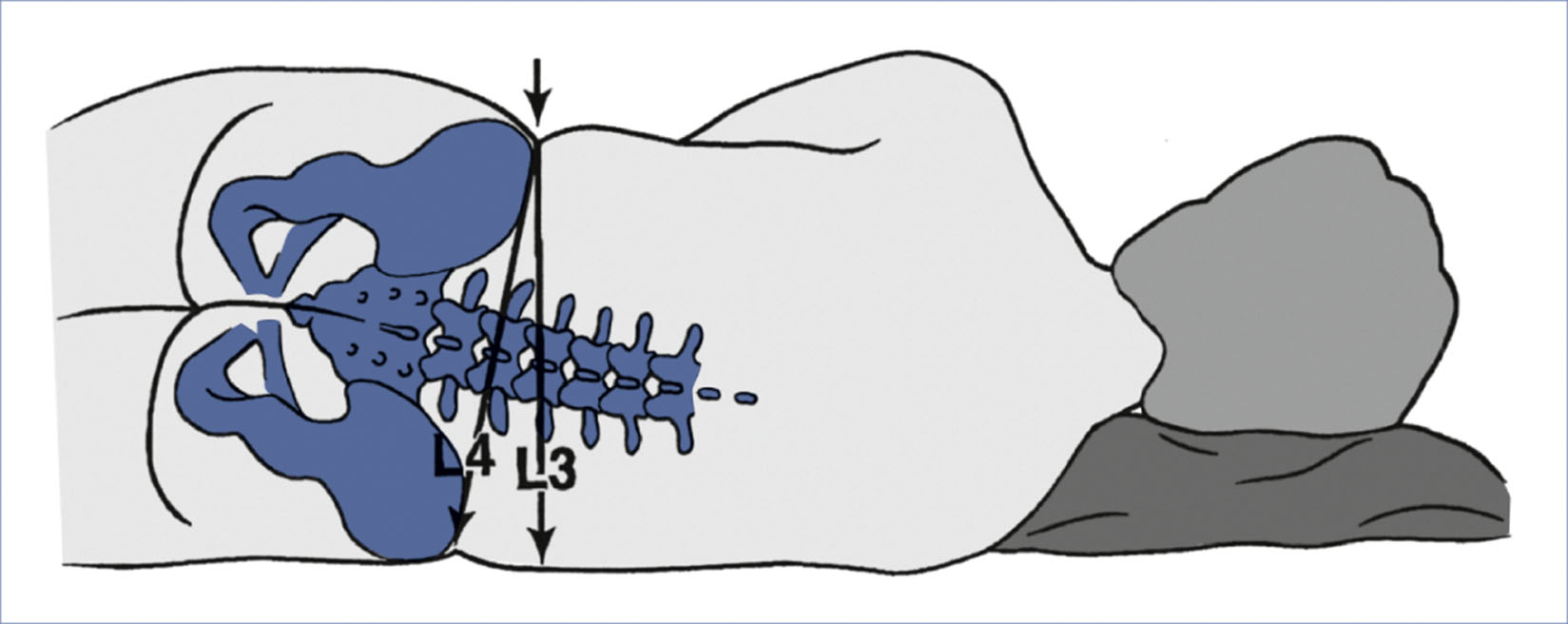 A diagram of a pregnant patient in the lateral position shows the alignment of Tuffier's line relative to L 3 and L 4 vertebrae.