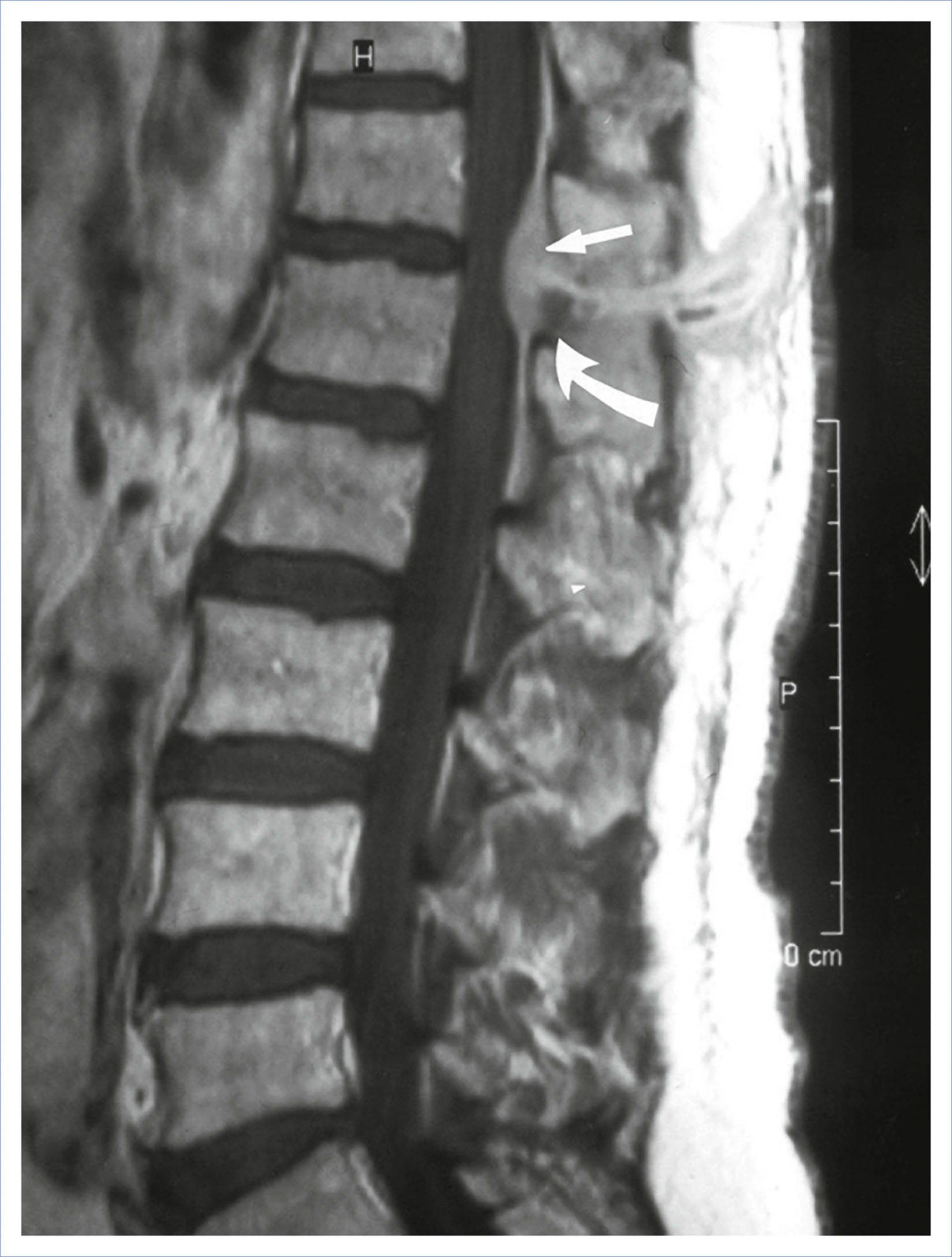 A midsagittal scan that shows a dorsal epidural mass at the T 12 to L 1 level.
