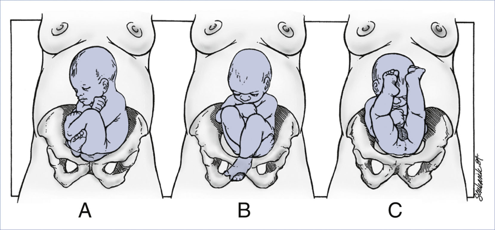 An illustration shows three types of breech fetal presentations labeled A, B, and C.