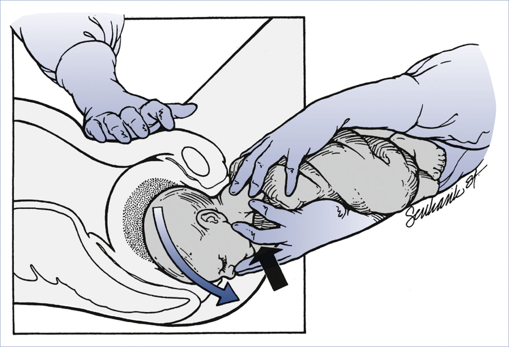 An illustration shows assisted vaginal breech delivery with pressure applied to the fetal maxilla and suprapubic region.