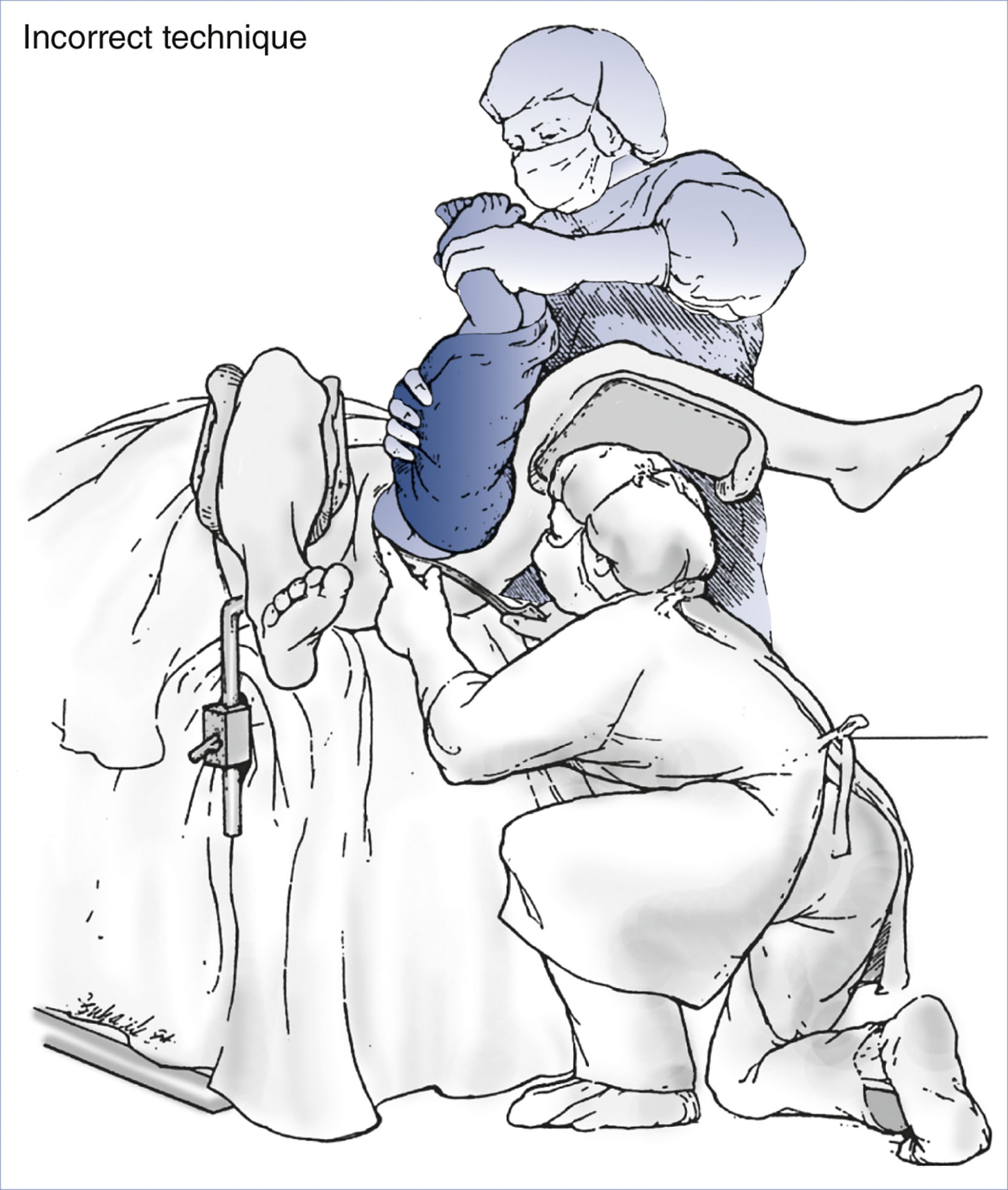 An illustration shows incorrect application of Piper forceps during vaginal breech delivery with fetal neck hyperextended.