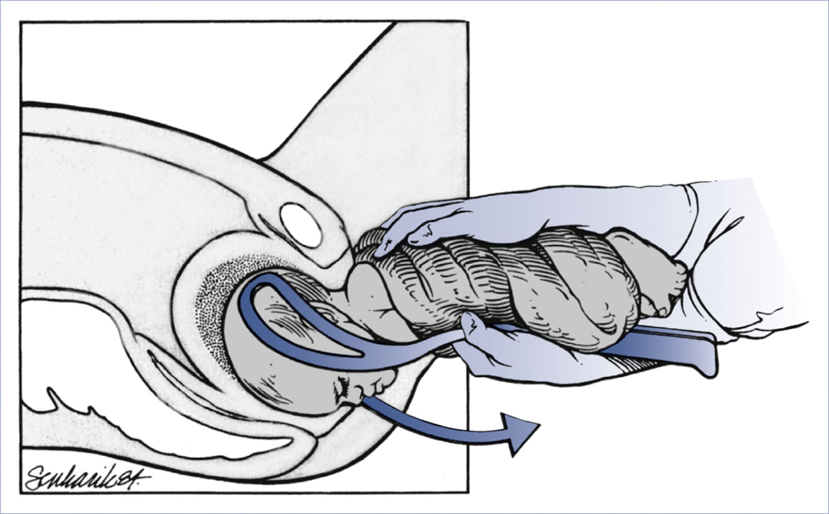An illustration shows controlled vaginal breech delivery using Piper forceps with traction aligned to the pelvic axis.